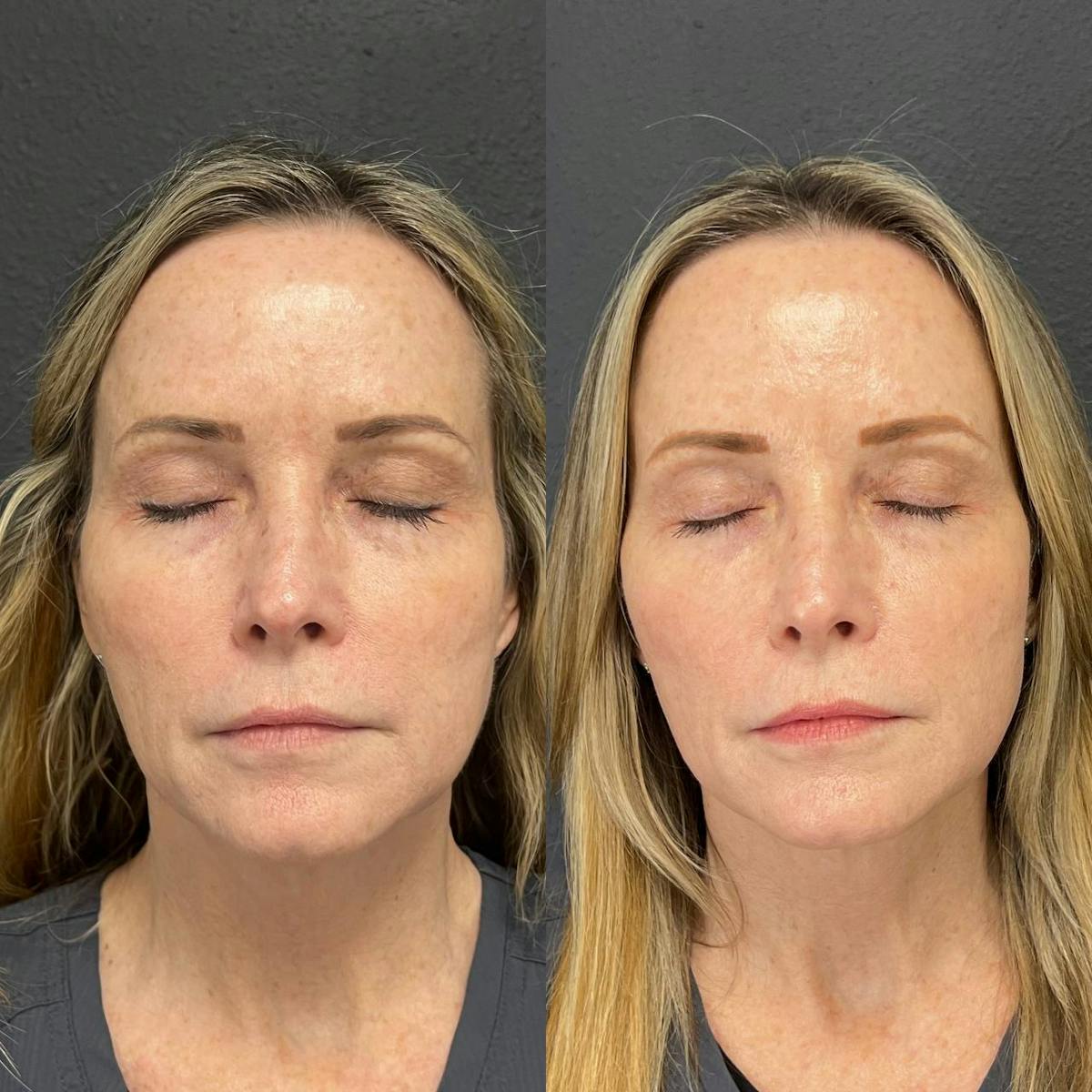 Plexr Before & After Gallery - Patient 123208 - Image 1