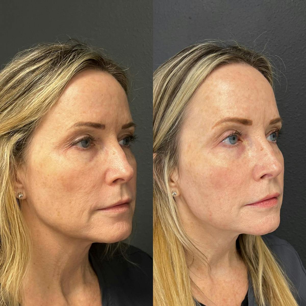 Plexr Before & After Gallery - Patient 123208 - Image 2
