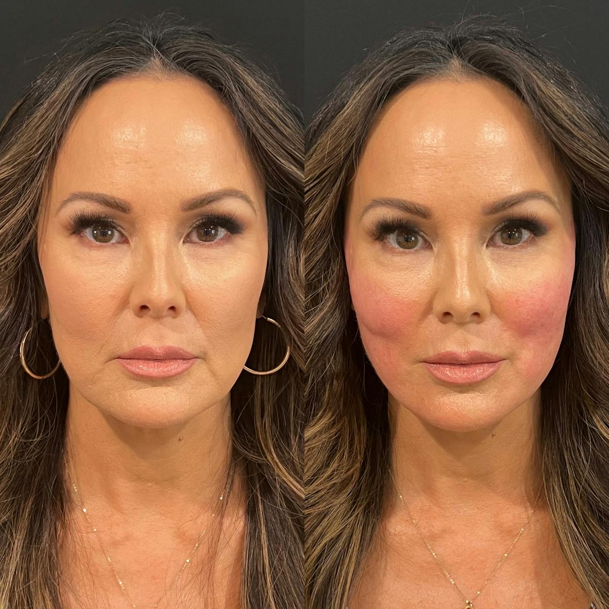 Threads Before & After Gallery - Patient 108593 - Image 1