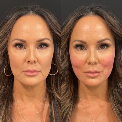 Threads Before & After Gallery - Patient 108593 - Image 1