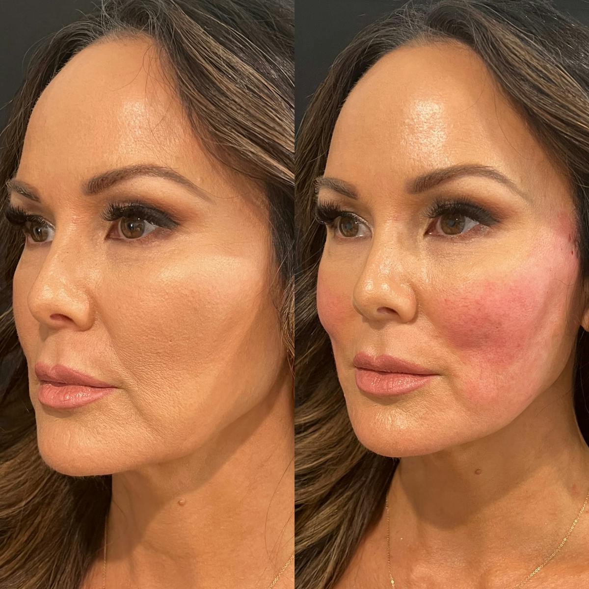 Threads Before & After Gallery - Patient 108593 - Image 2