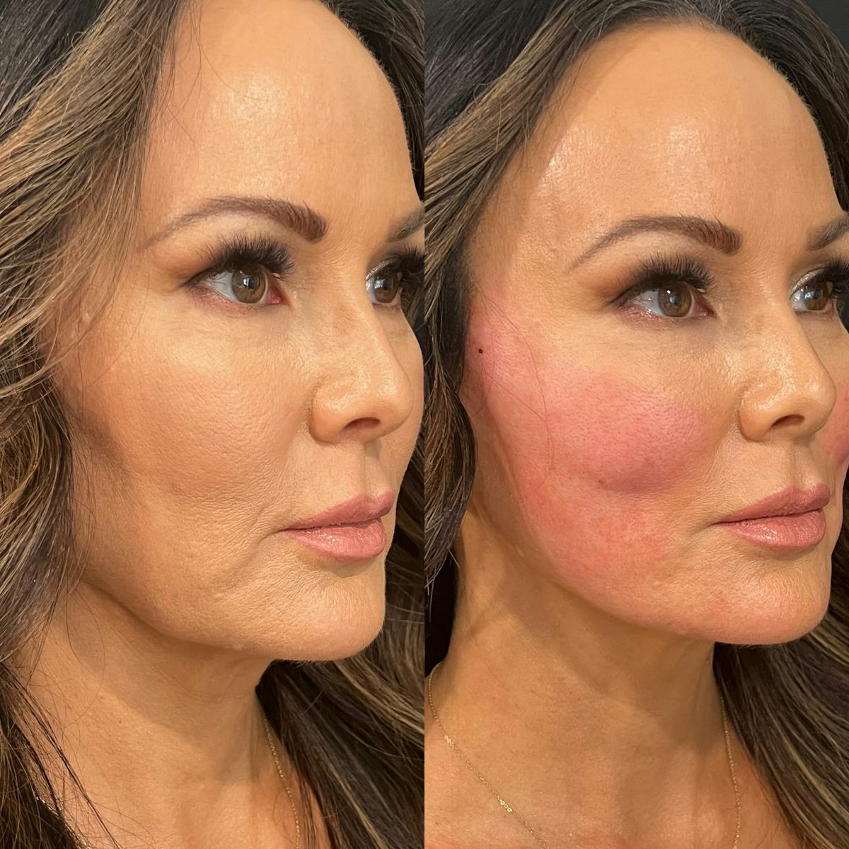 Threads Before & After Gallery - Patient 108593 - Image 3