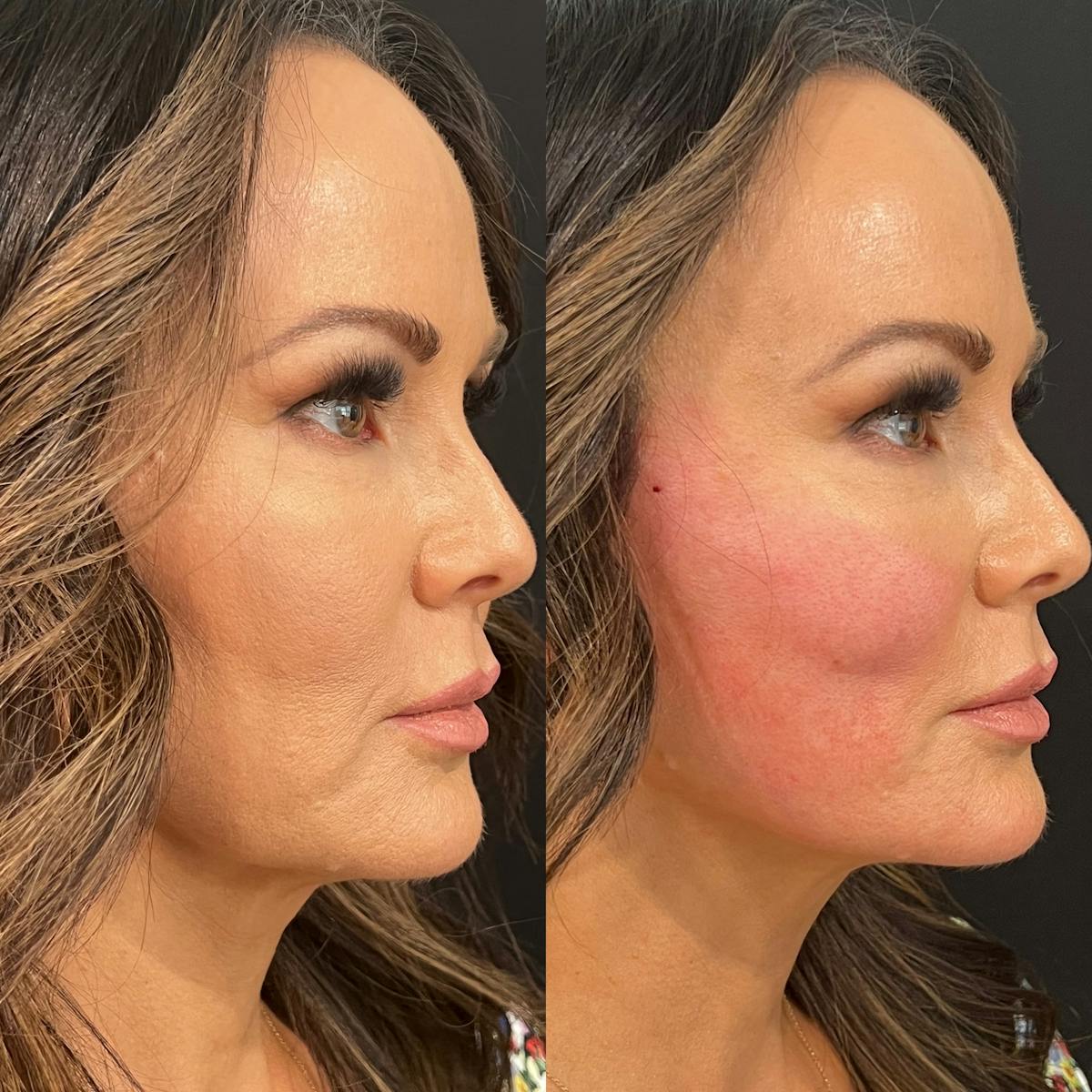 Threads Before & After Gallery - Patient 108593 - Image 4