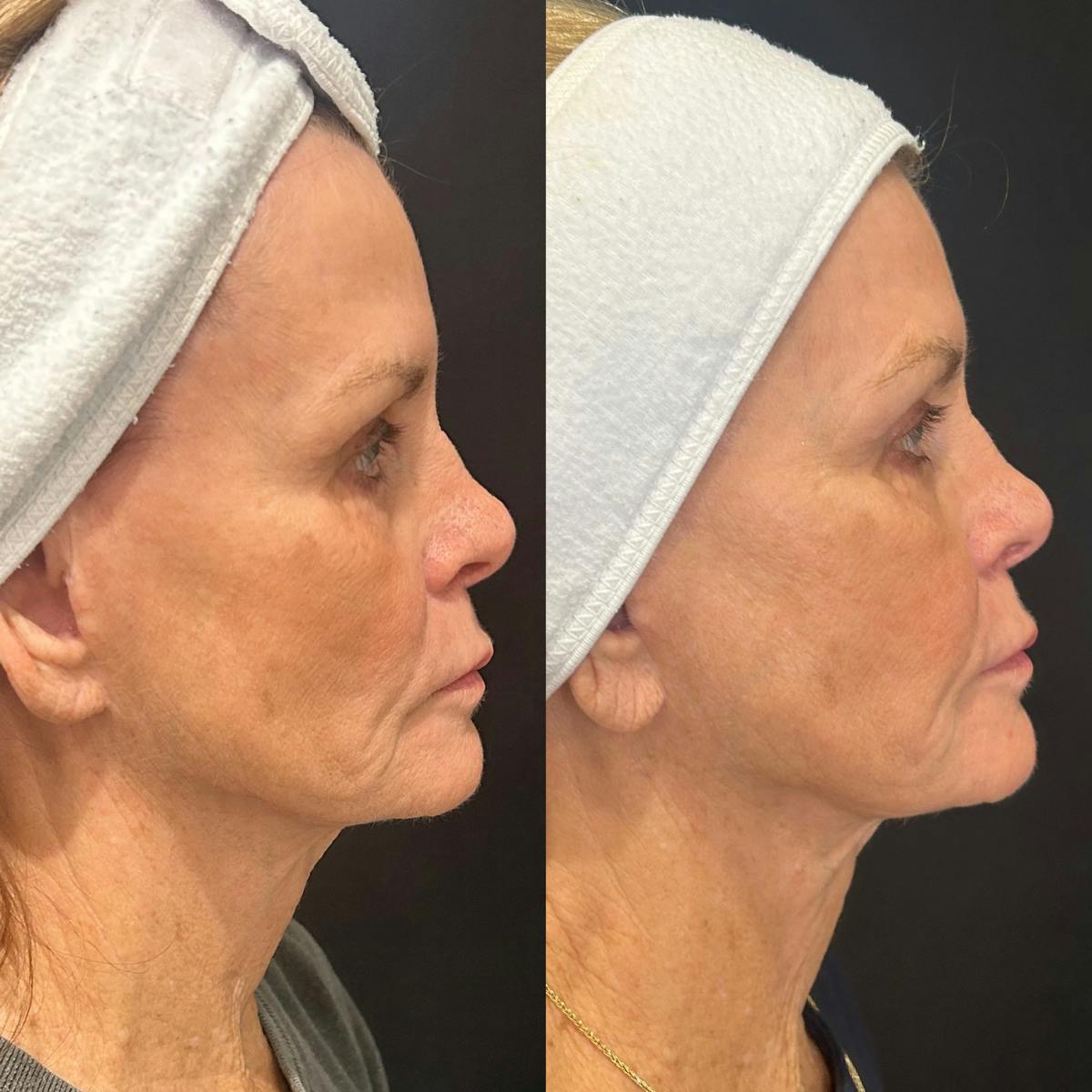 Ultherapy Before & After Gallery - Patient 396222 - Image 1