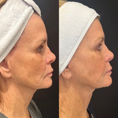 Ultherapy Before & After Gallery - Patient 396222 - Image 1