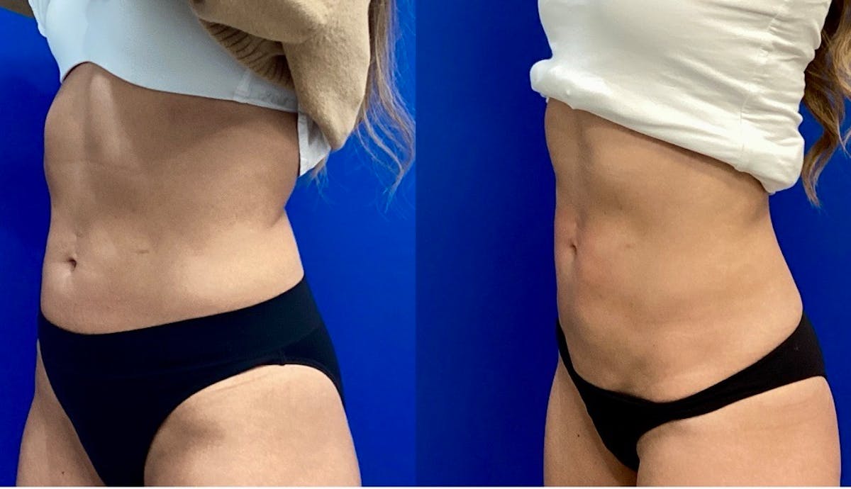 Emsculpt Before & After Gallery - Patient 546581 - Image 2