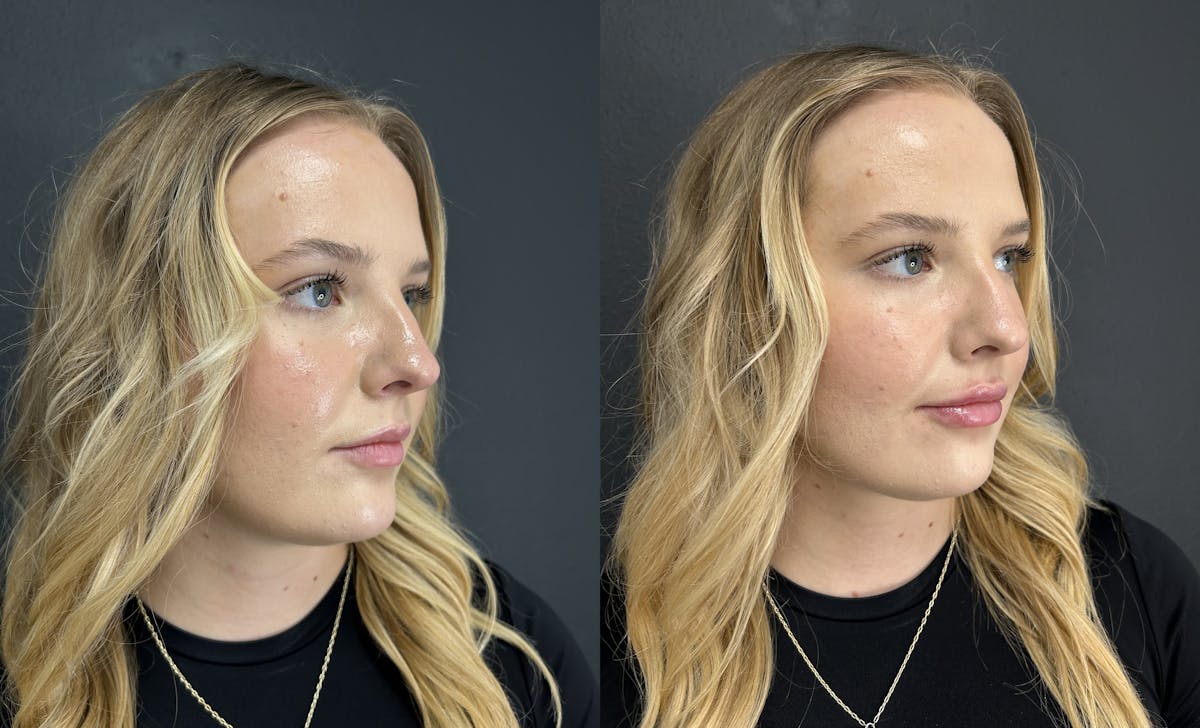 Facial Fillers Before & After Gallery - Patient 245722 - Image 1