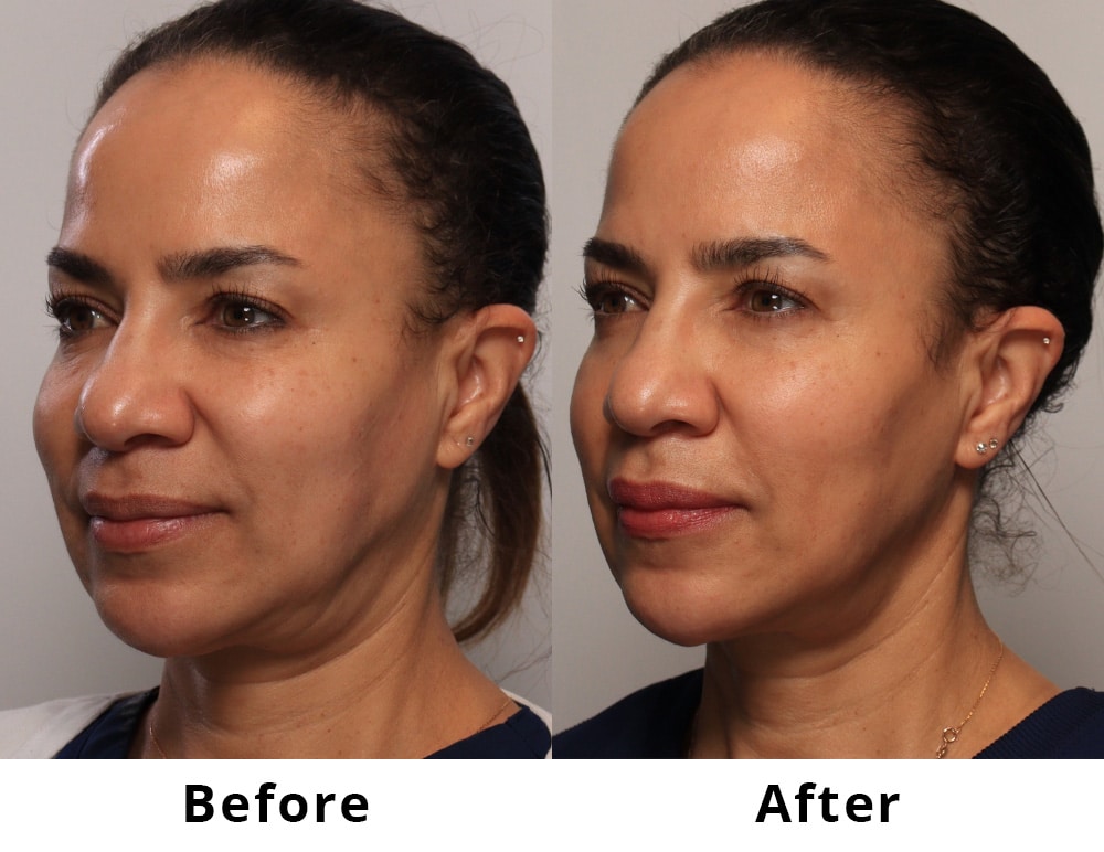 Before & After