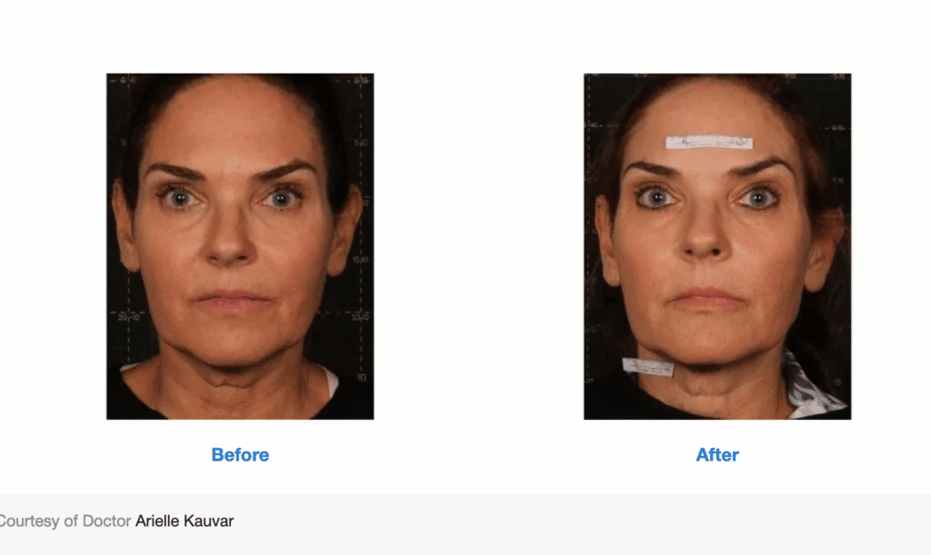 Treatment results screenshot