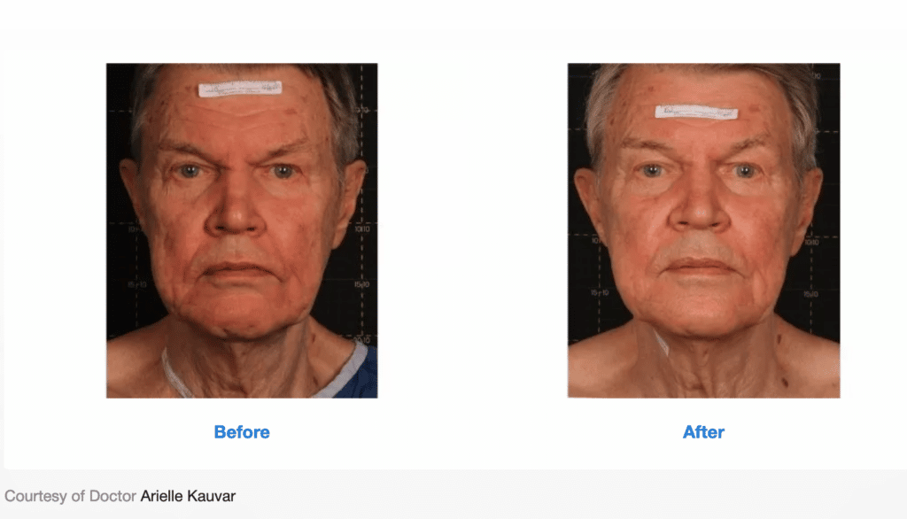 Treatment results screenshot