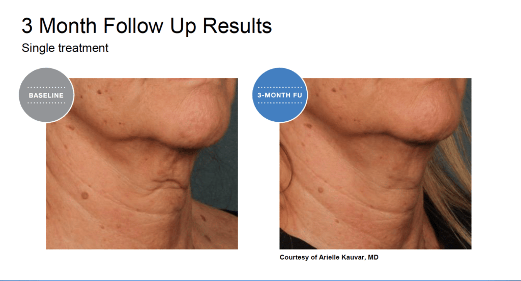 Treatment results screenshot
