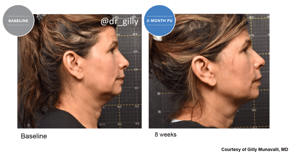 Treatment results screenshot