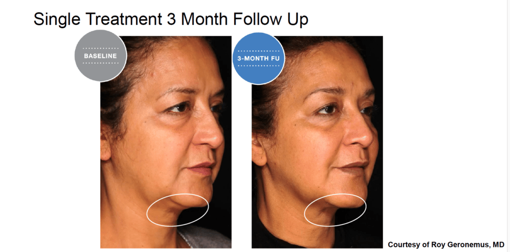 Treatment results screenshot