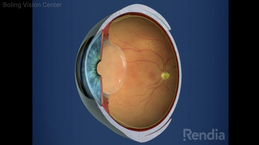 Refractive Lens Exchange retina image