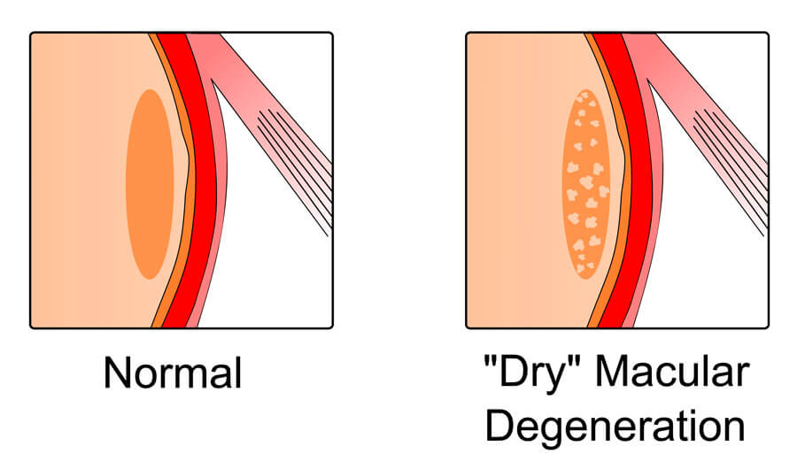 Dry Macular Degeneration graphic