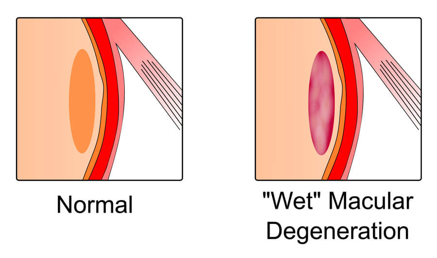 Wet AMD graphic