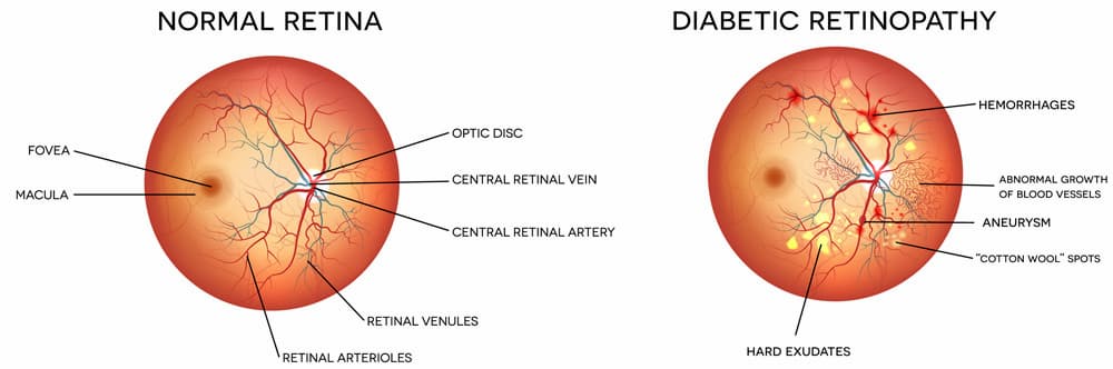 Diabetic Retinopathy graphic