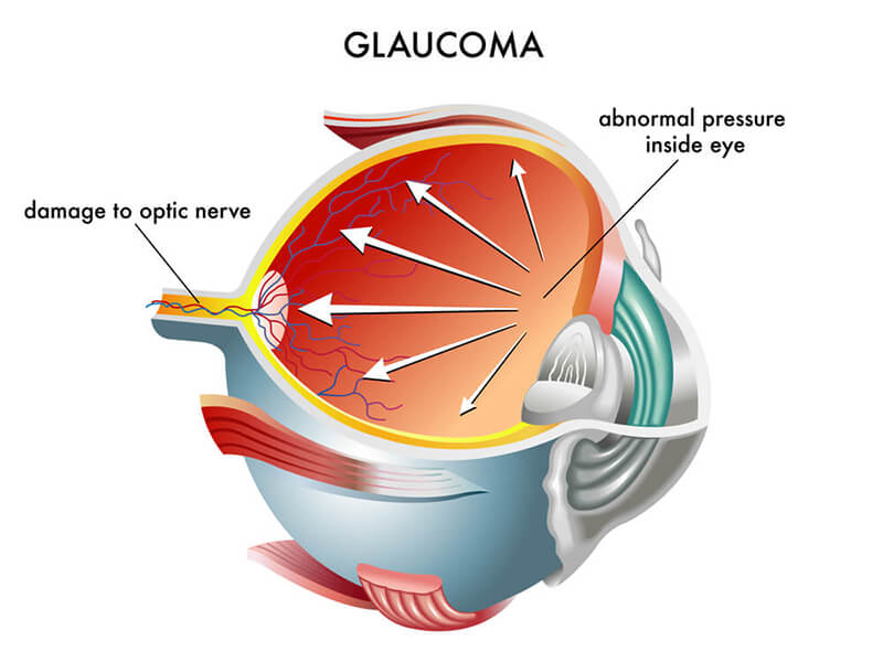 glaucoma infographic