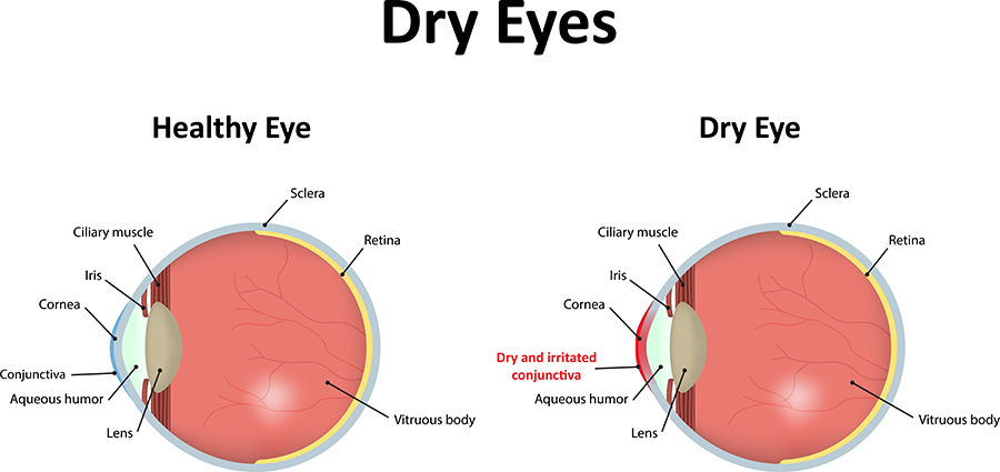 dry eye graphic