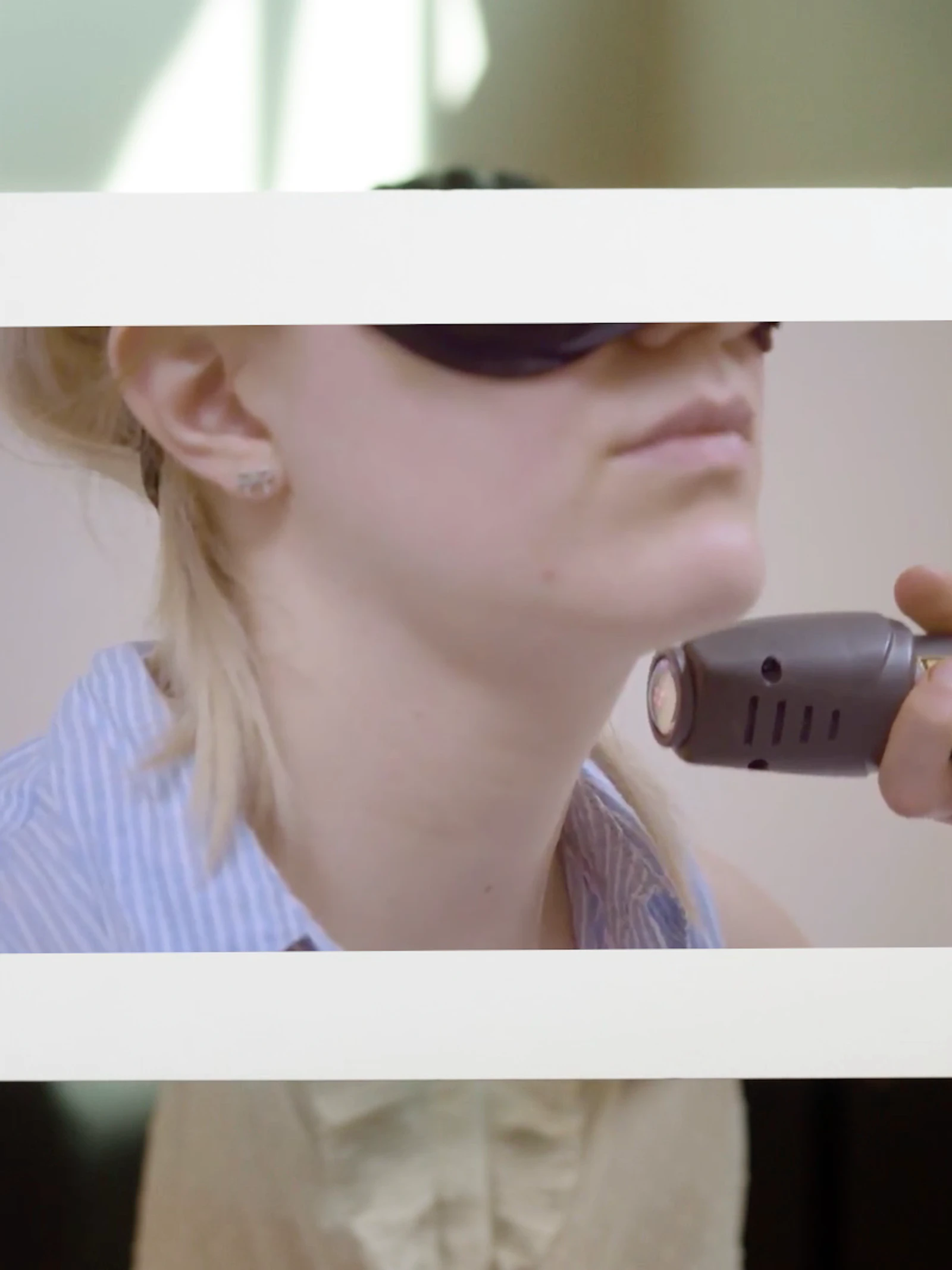 Kan lichttherapie brandwonden voorkomen?