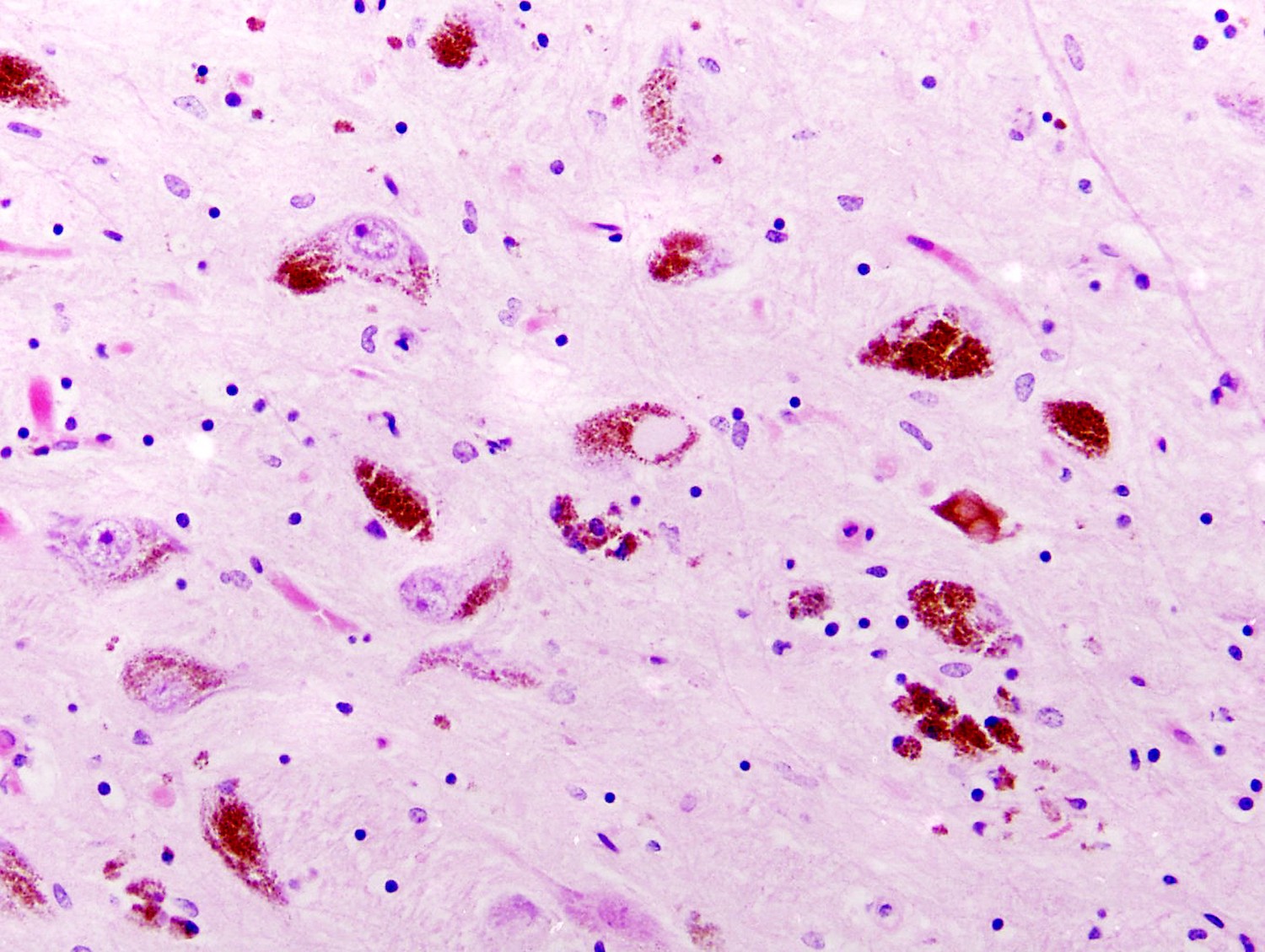 Parkinson valt op te sporen vóór eerste symptomen ontstaan