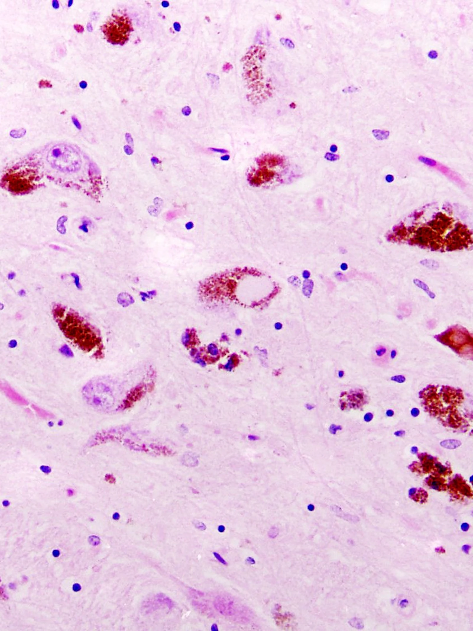 Parkinson valt op te sporen vóór eerste symptomen ontstaan