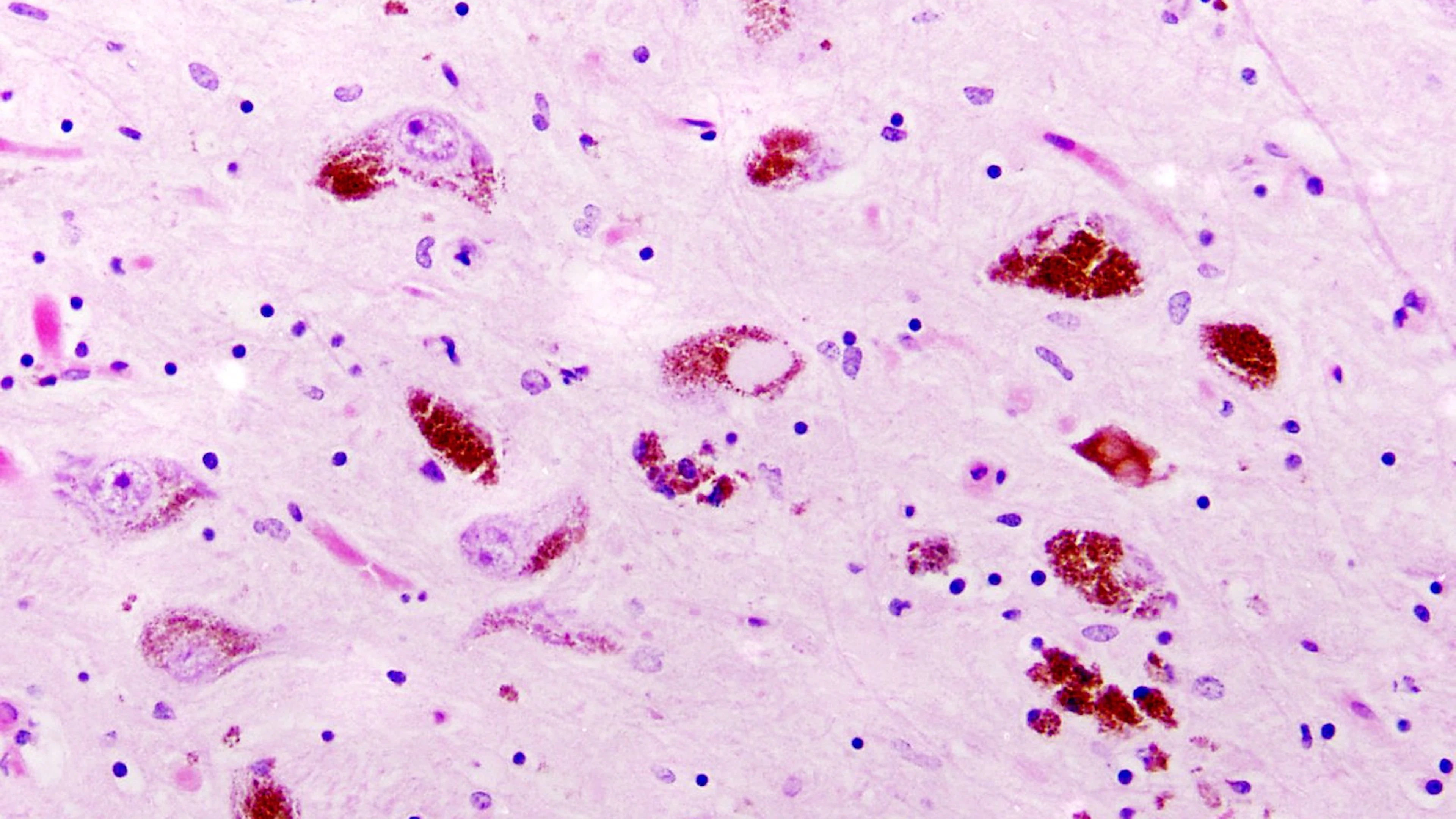 Parkinson valt op te sporen vóór eerste symptomen ontstaan
