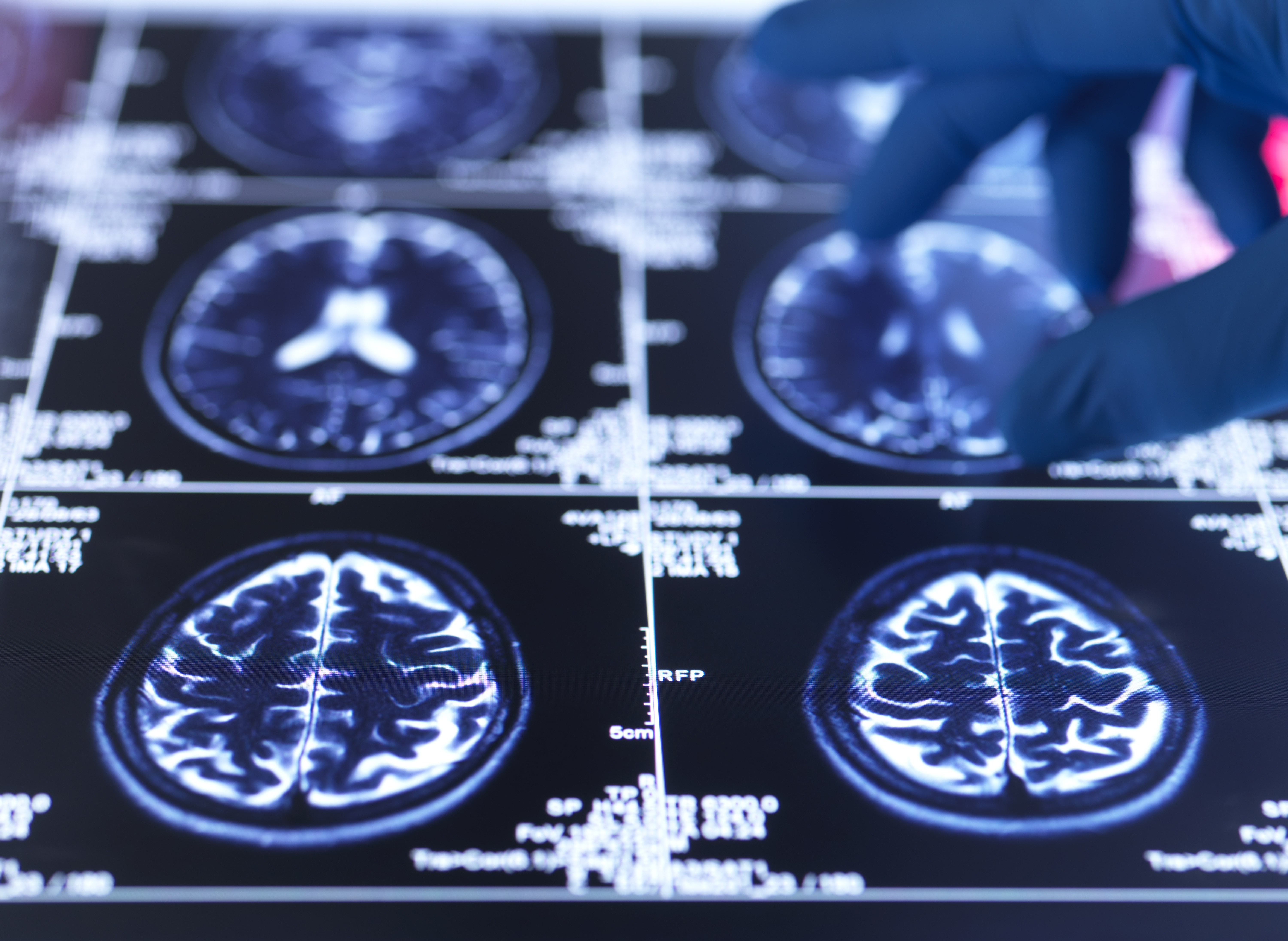 Nieuwe methode voorspelt dementie tot negen jaar voor de diagnose