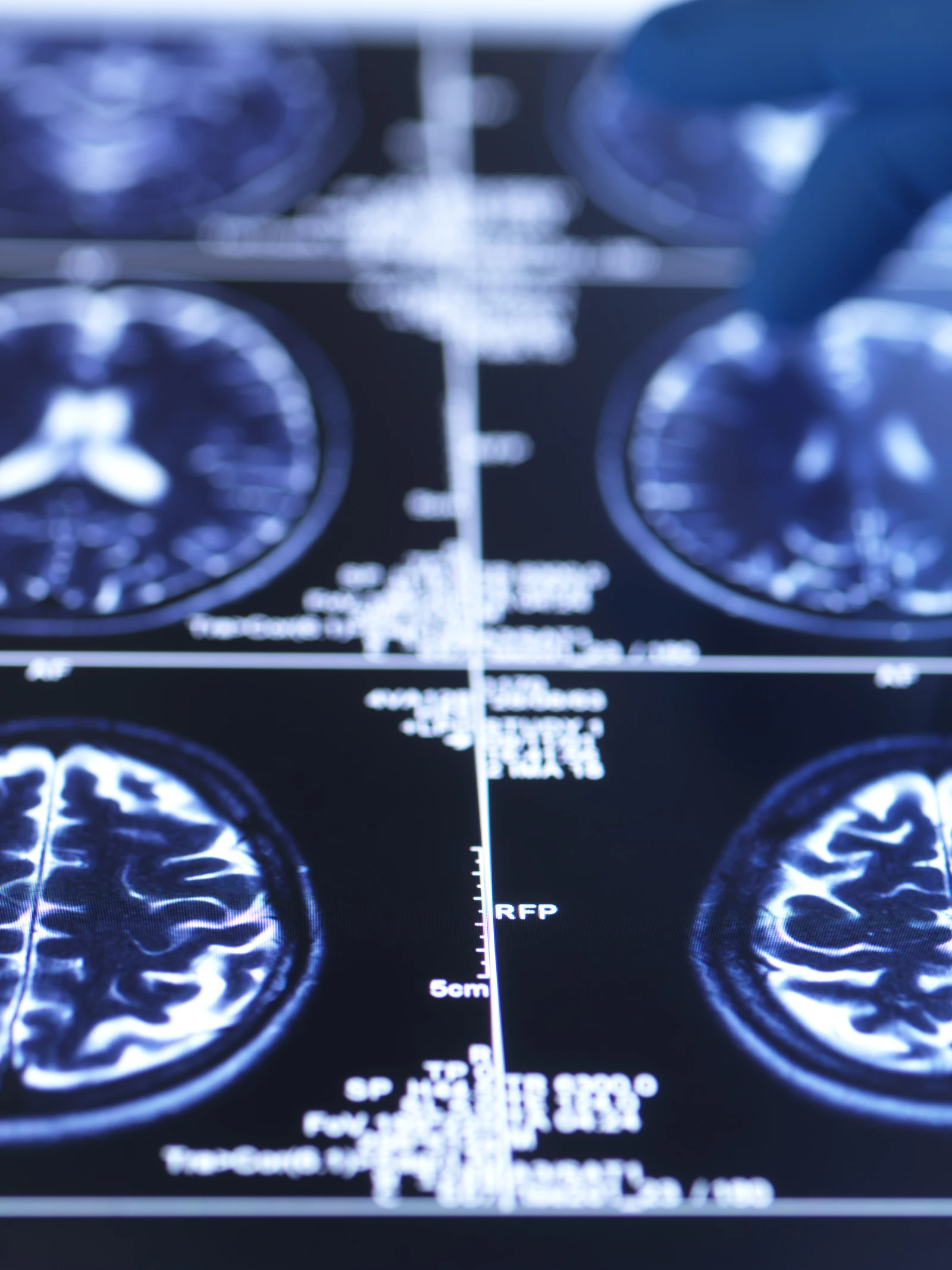 Nieuwe methode voorspelt dementie tot negen jaar voor de diagnose