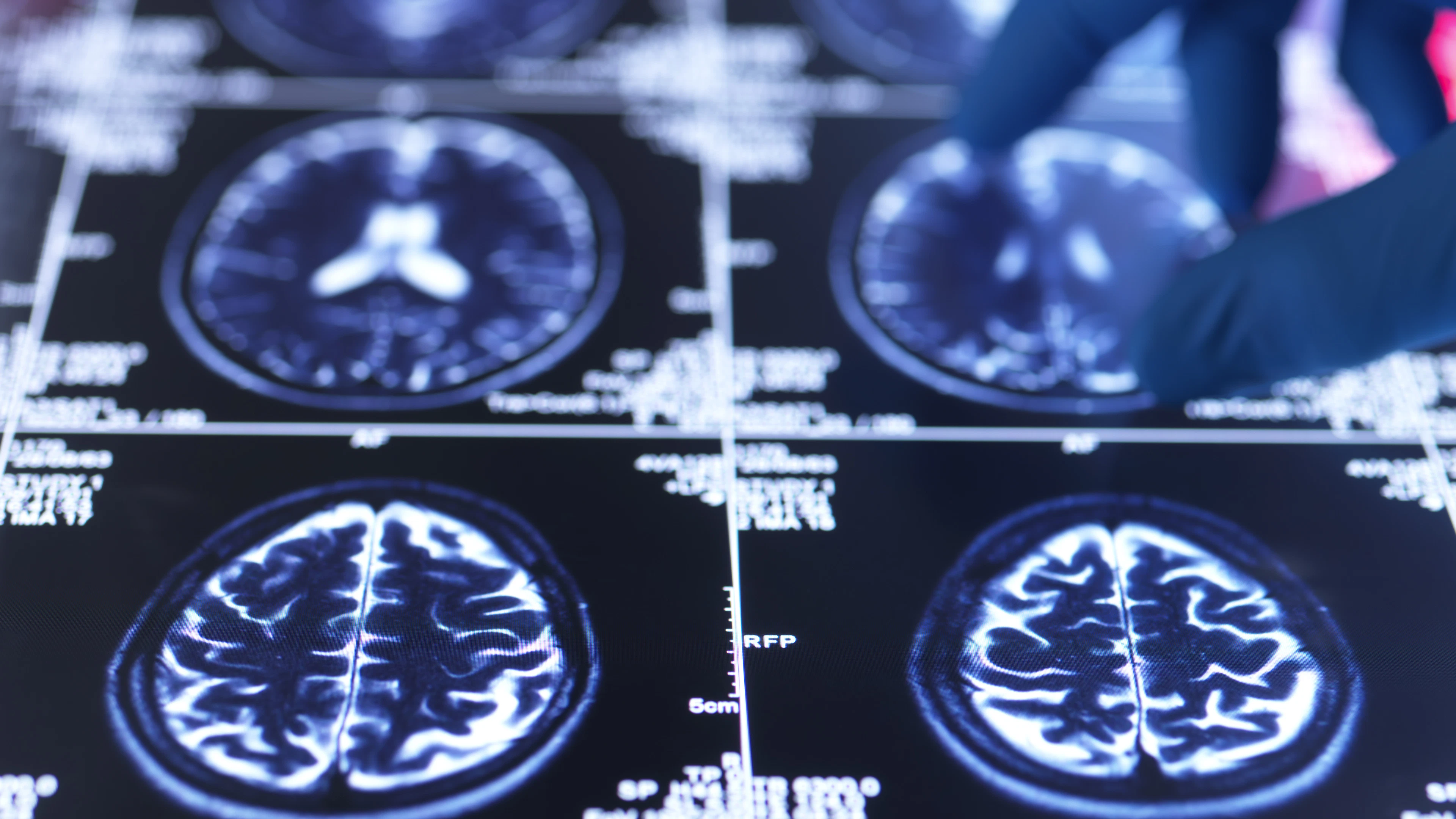 Nieuwe methode voorspelt dementie tot negen jaar voor de diagnose