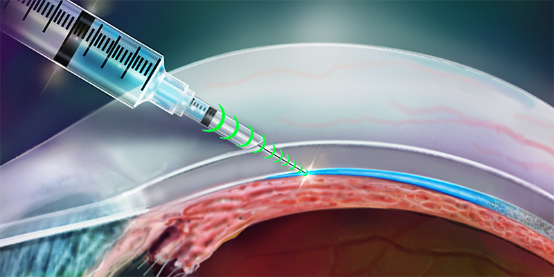 Intelligente injectienaald raakt overal zonder weefsels te beschadigen