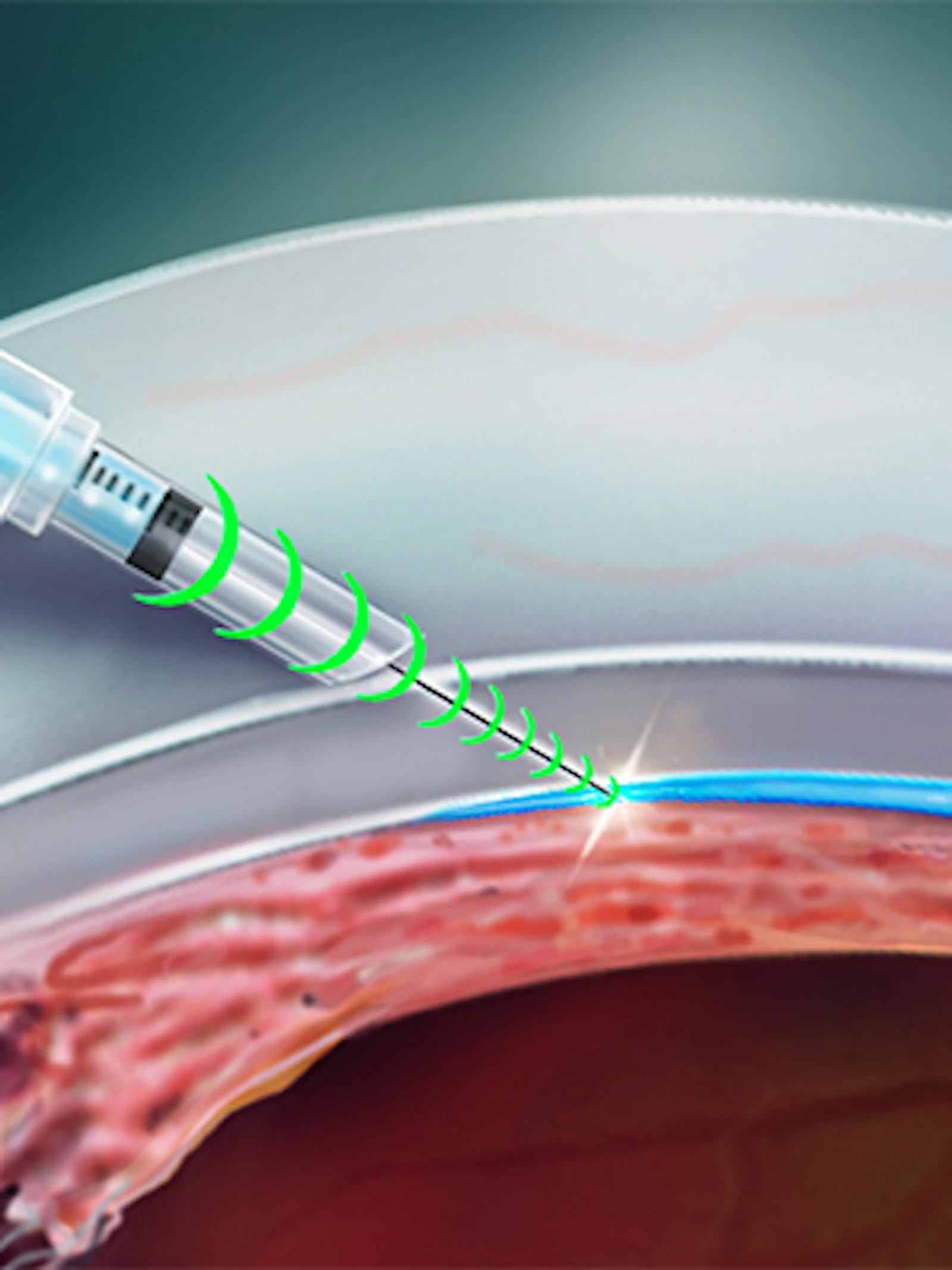Intelligente injectienaald raakt overal zonder weefsels te beschadigen