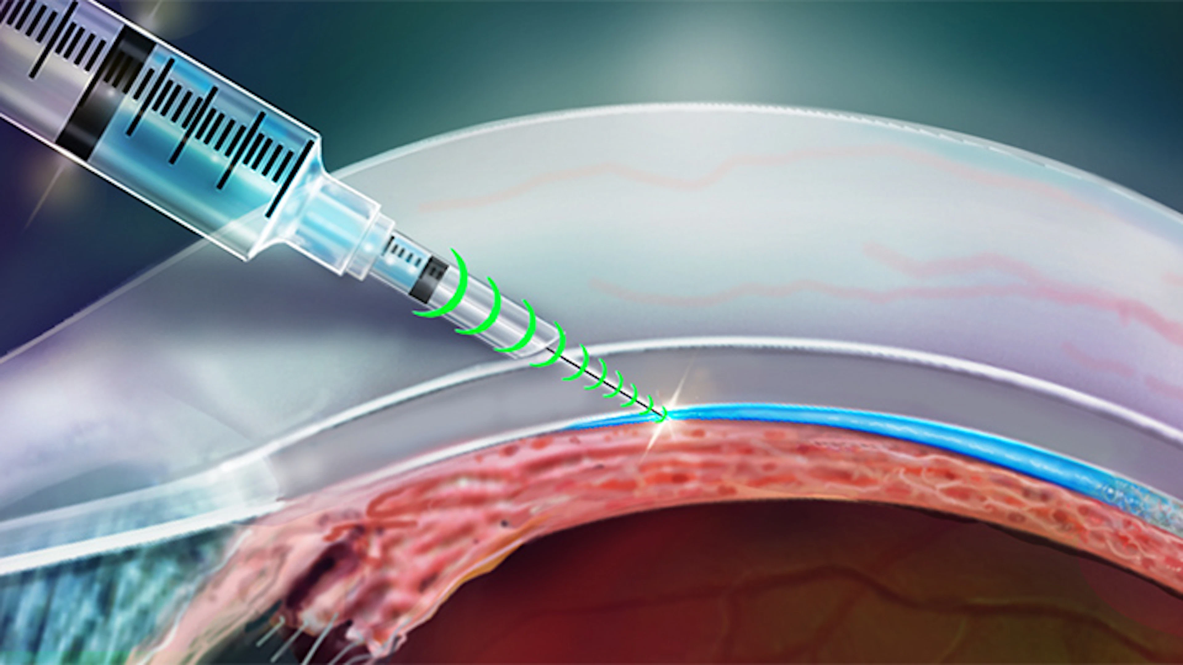 Intelligente injectienaald raakt overal zonder weefsels te beschadigen