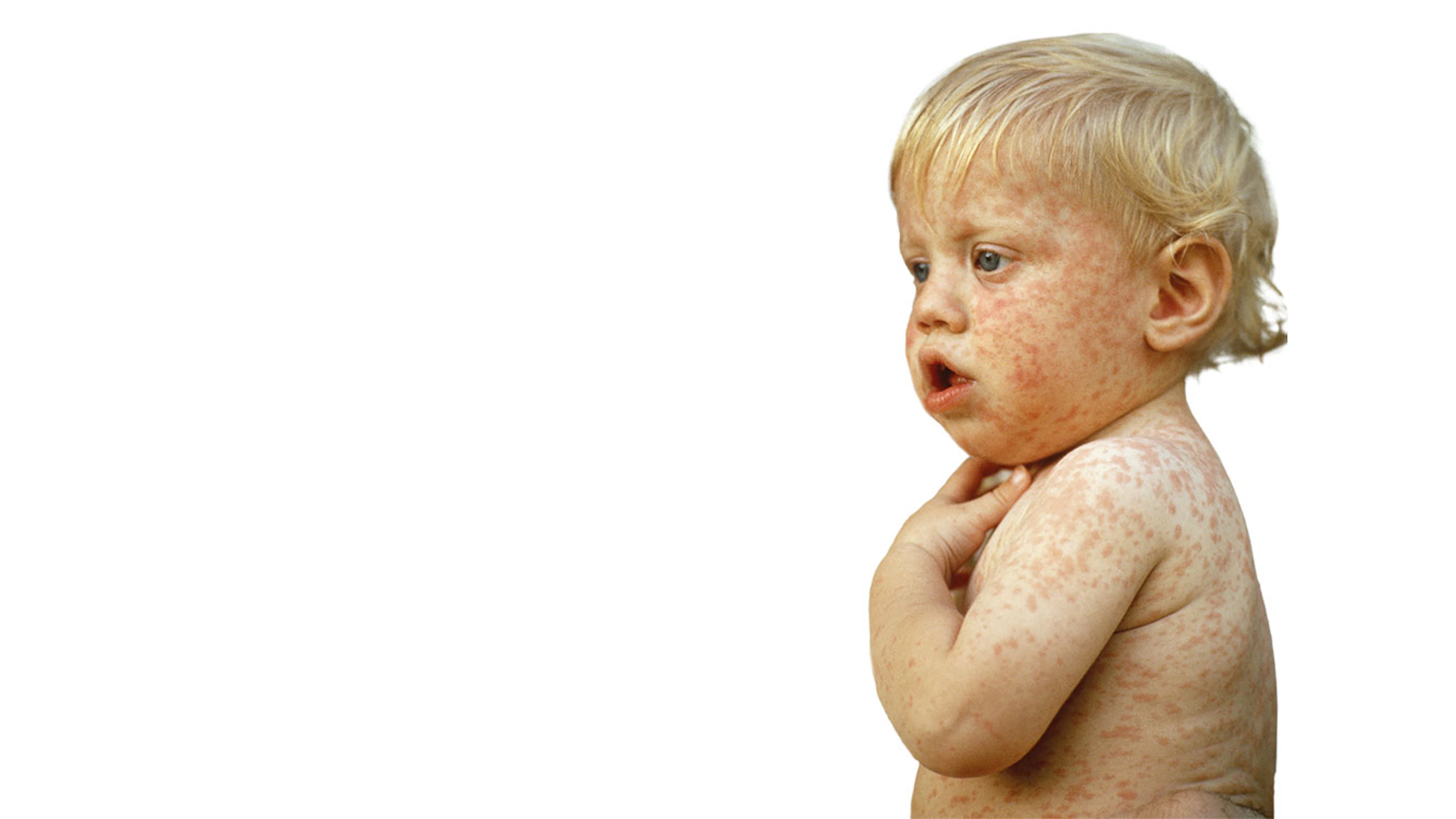 Strategieën om vaccinweigeraars te overtuigen