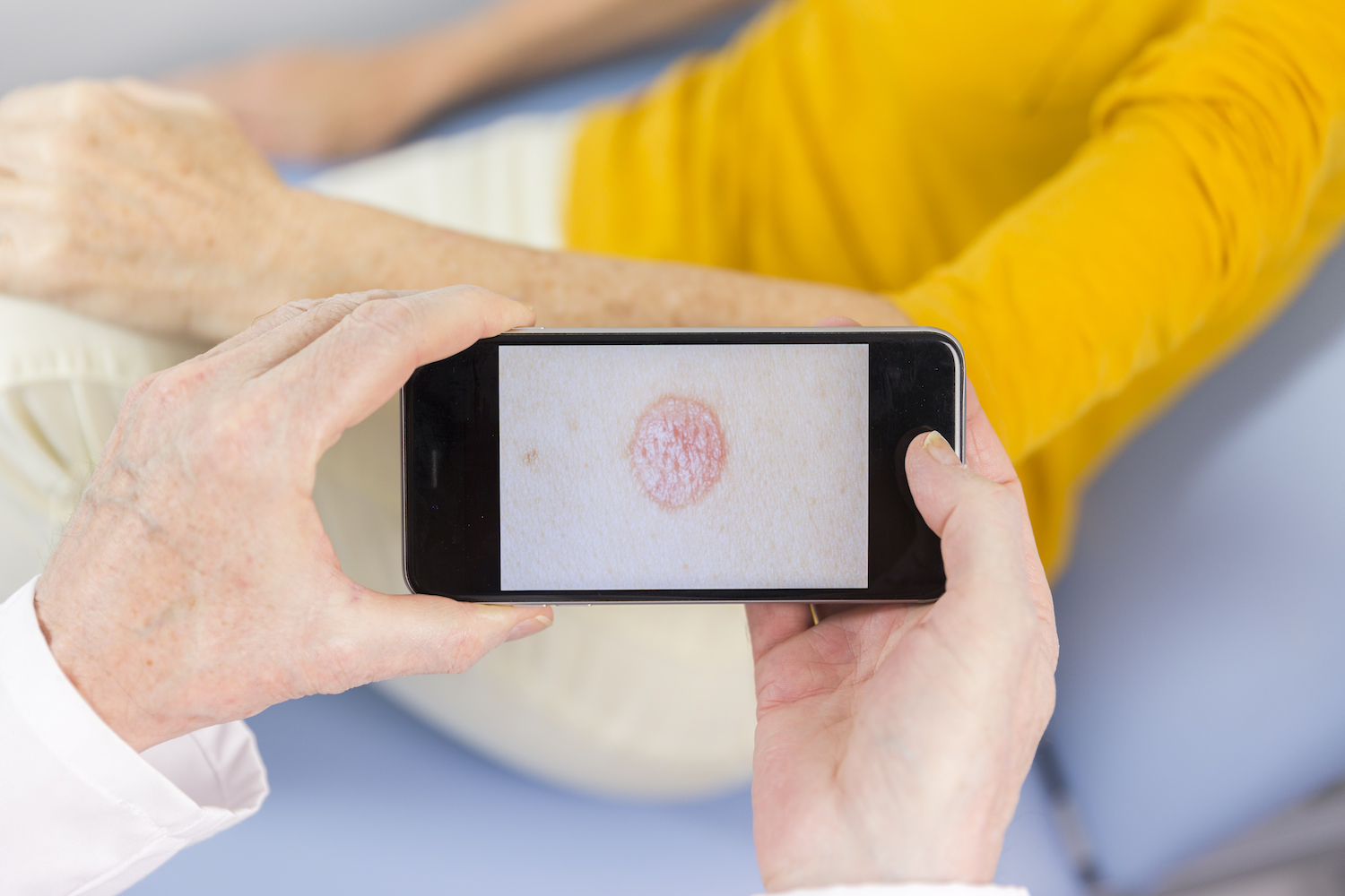 Psoriasis gaat gepaard met psychische stoornissen
