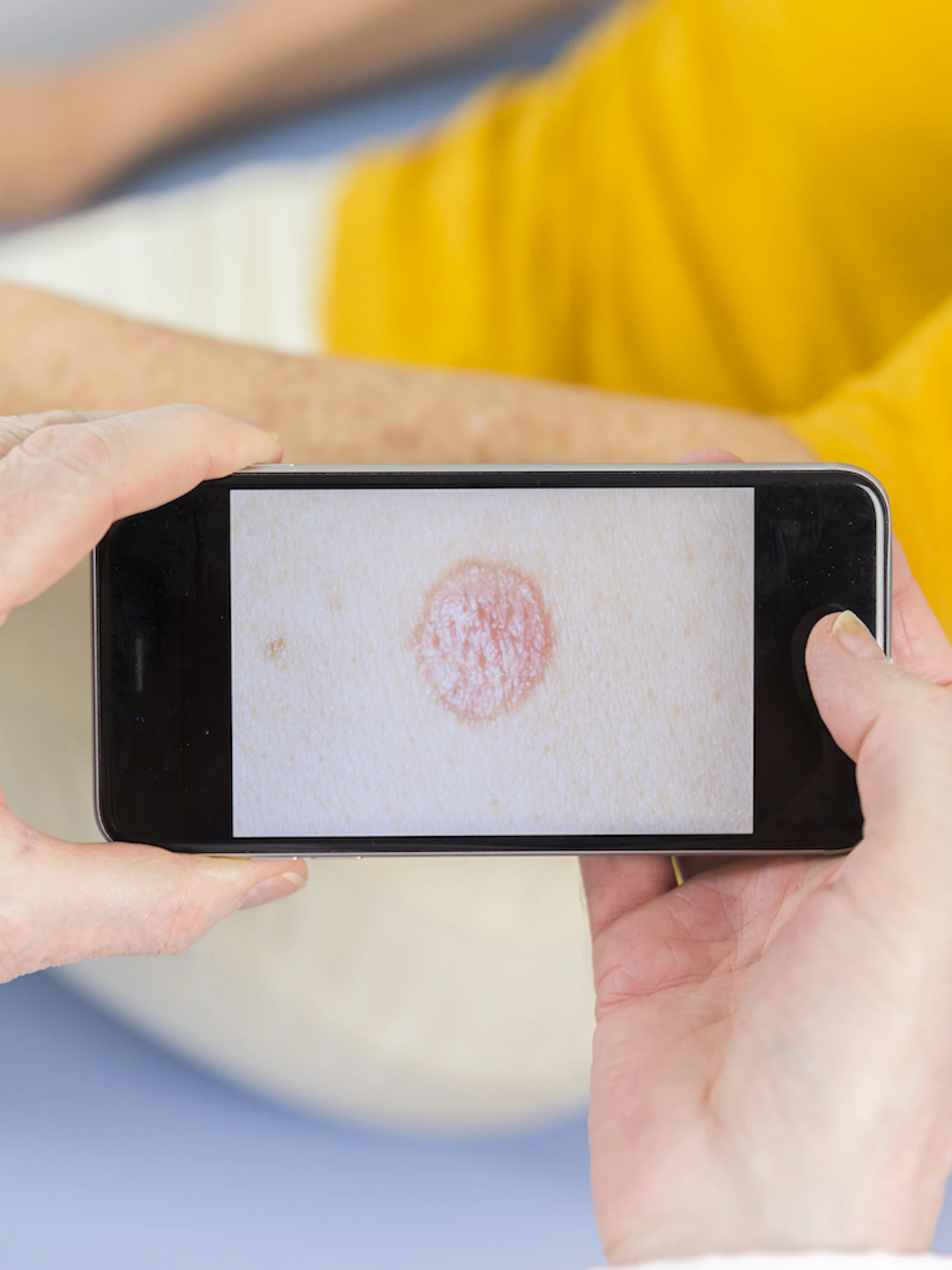 Psoriasis gaat gepaard met psychische stoornissen