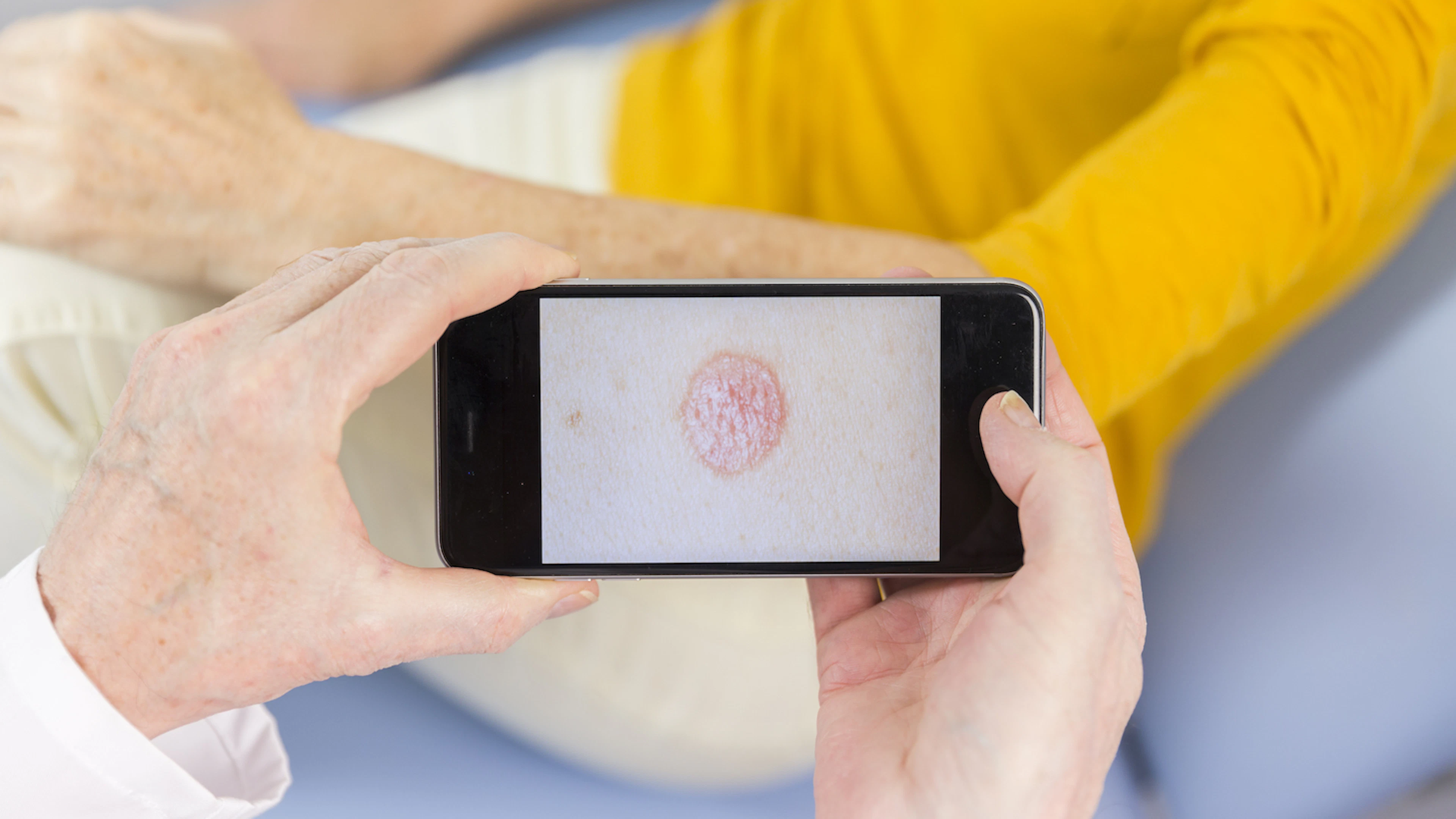 Psoriasis gaat gepaard met psychische stoornissen