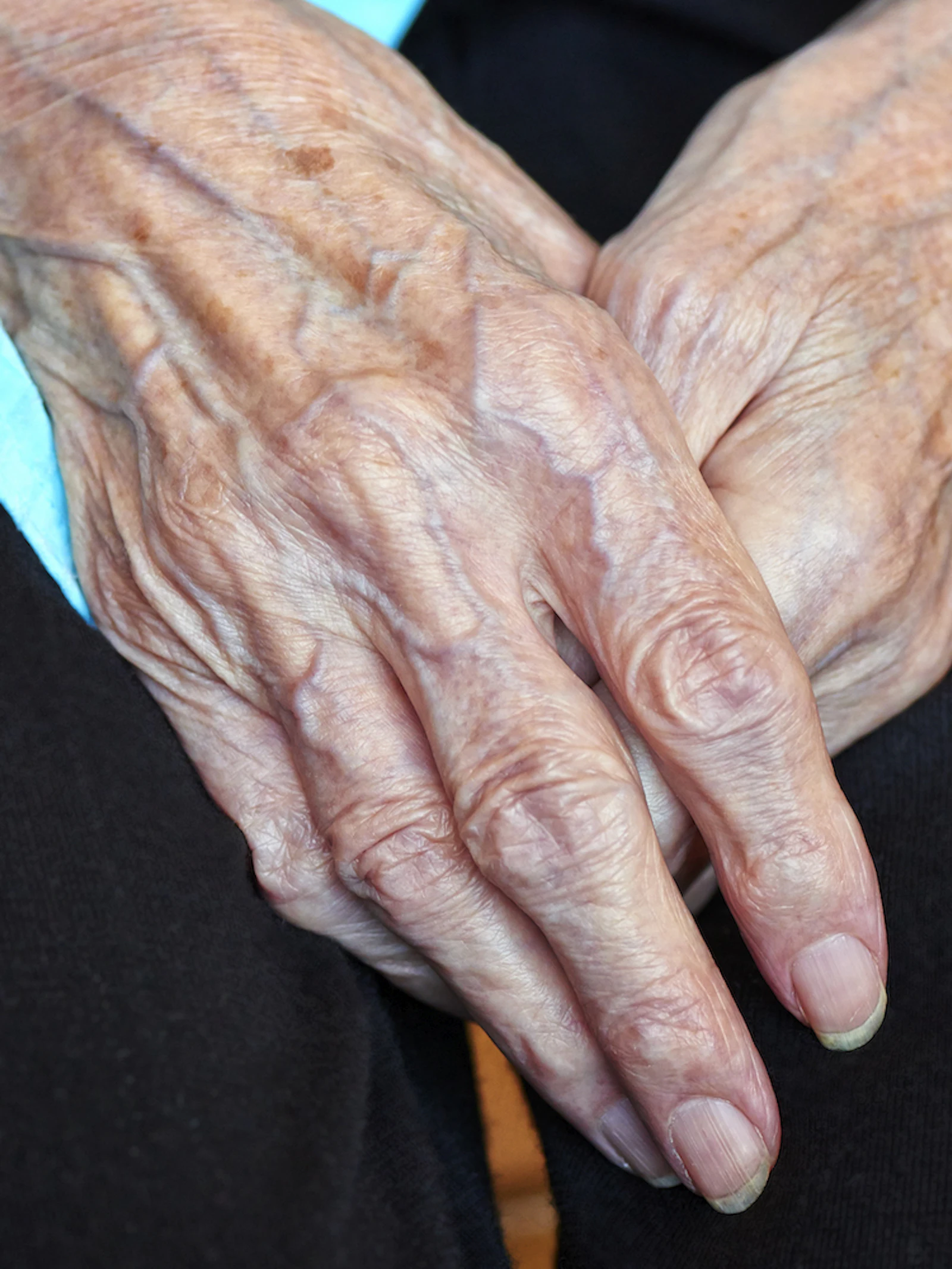Nieuwe behandeling voor artritis?