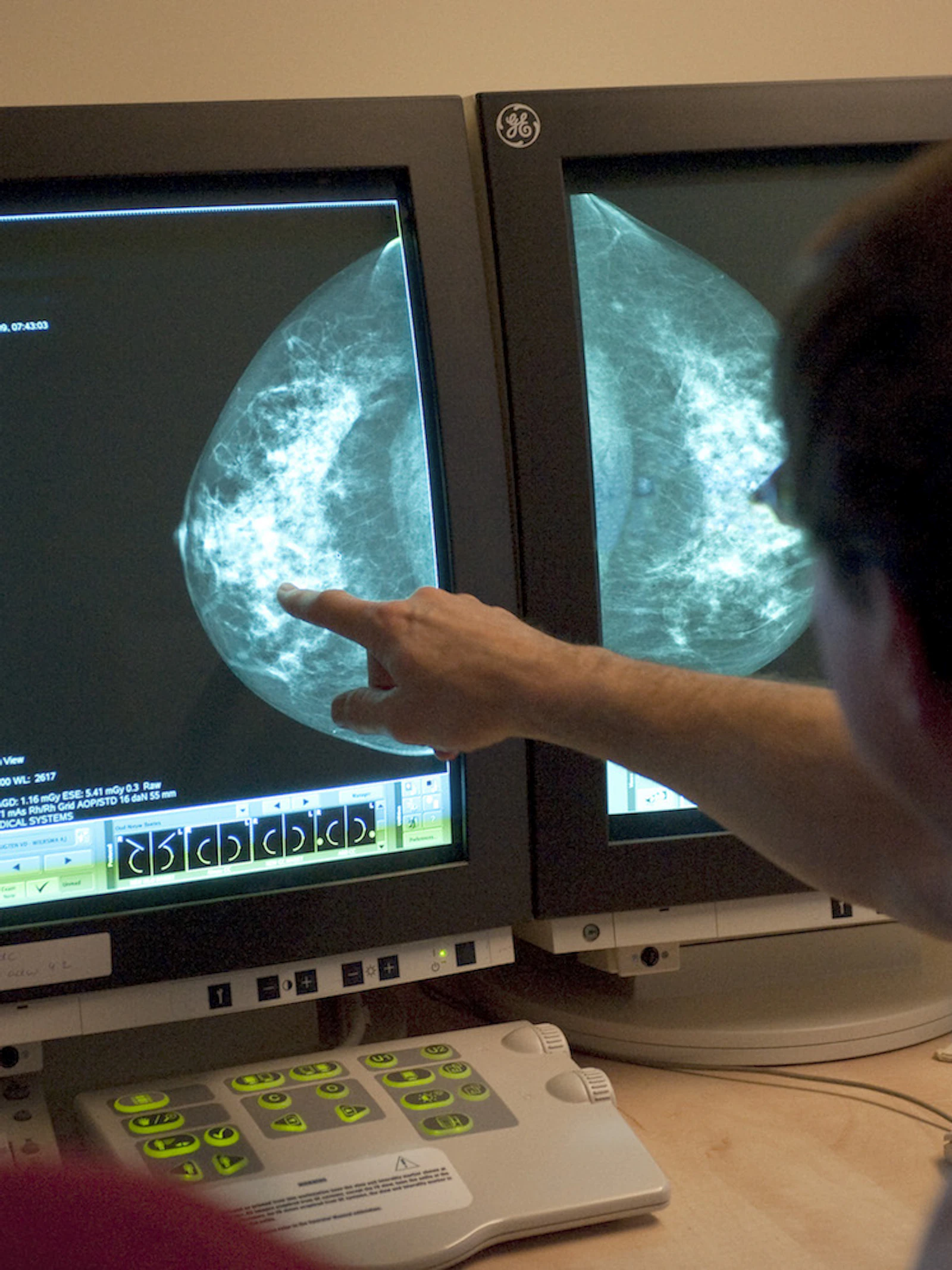 Kunnen slimme computerprogramma's borstkanker opsporen?