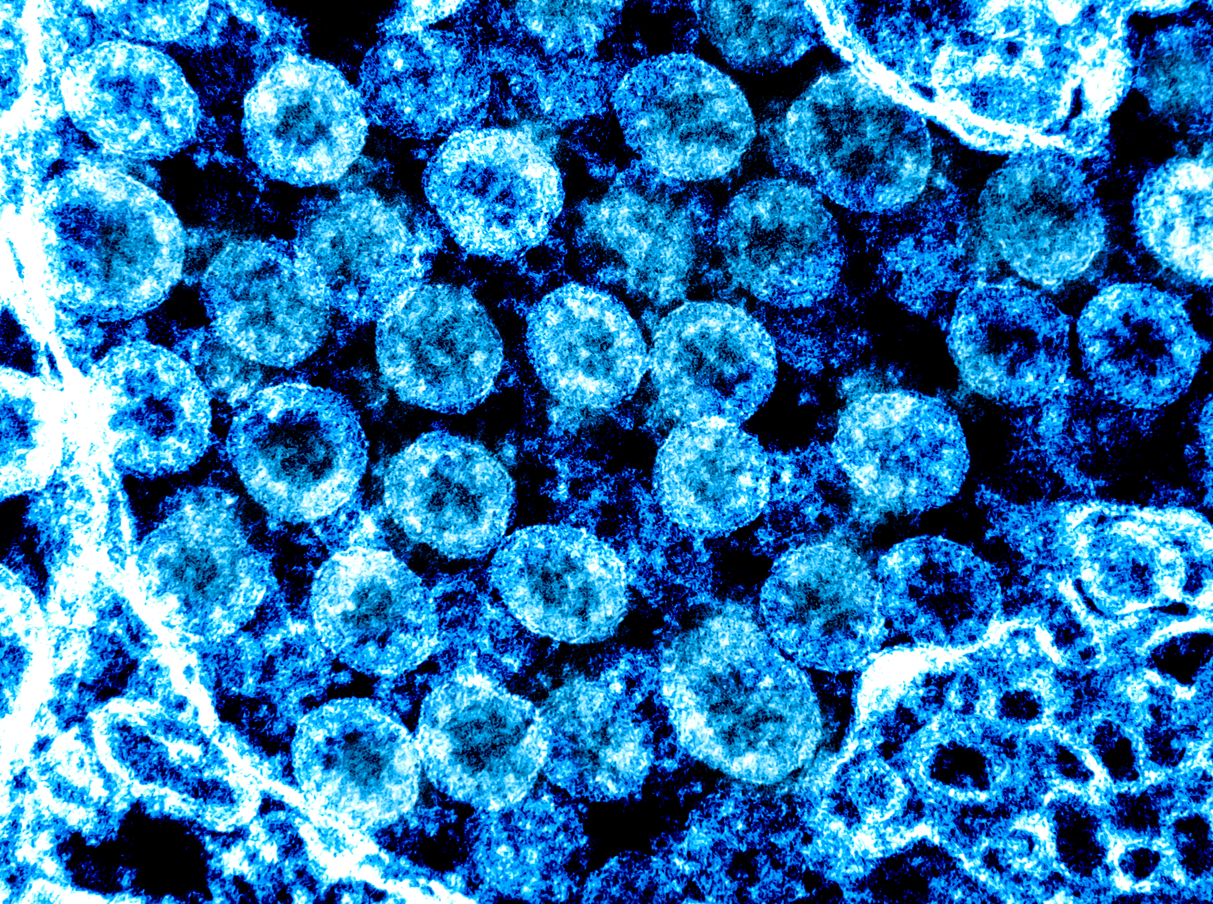 Helpt bestaande reumamedicatie in de strijd tegen covid-19-infectie?