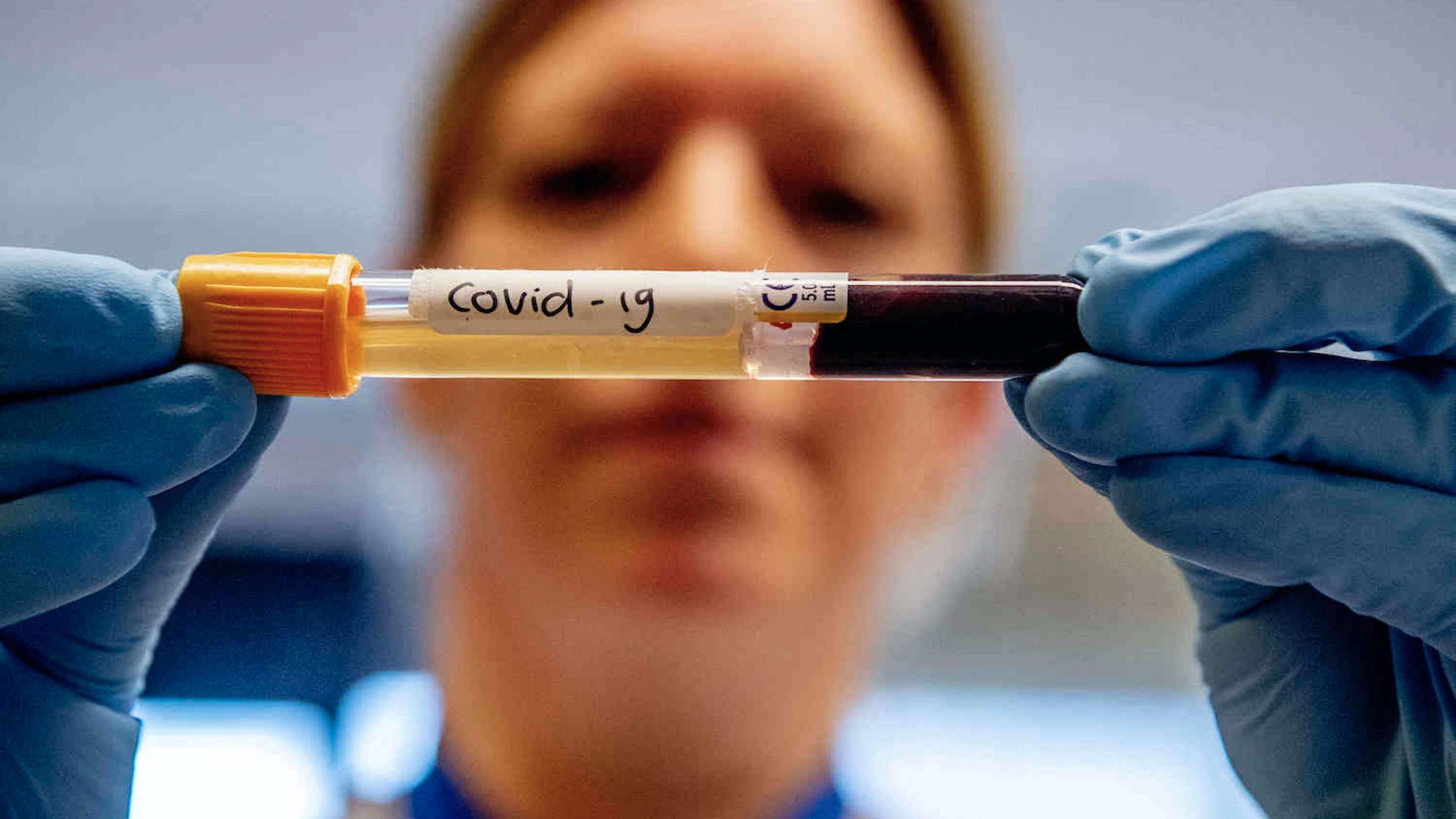 Waarom mannen kwetsbaarder zijn voor het coronavirus dan vrouwen