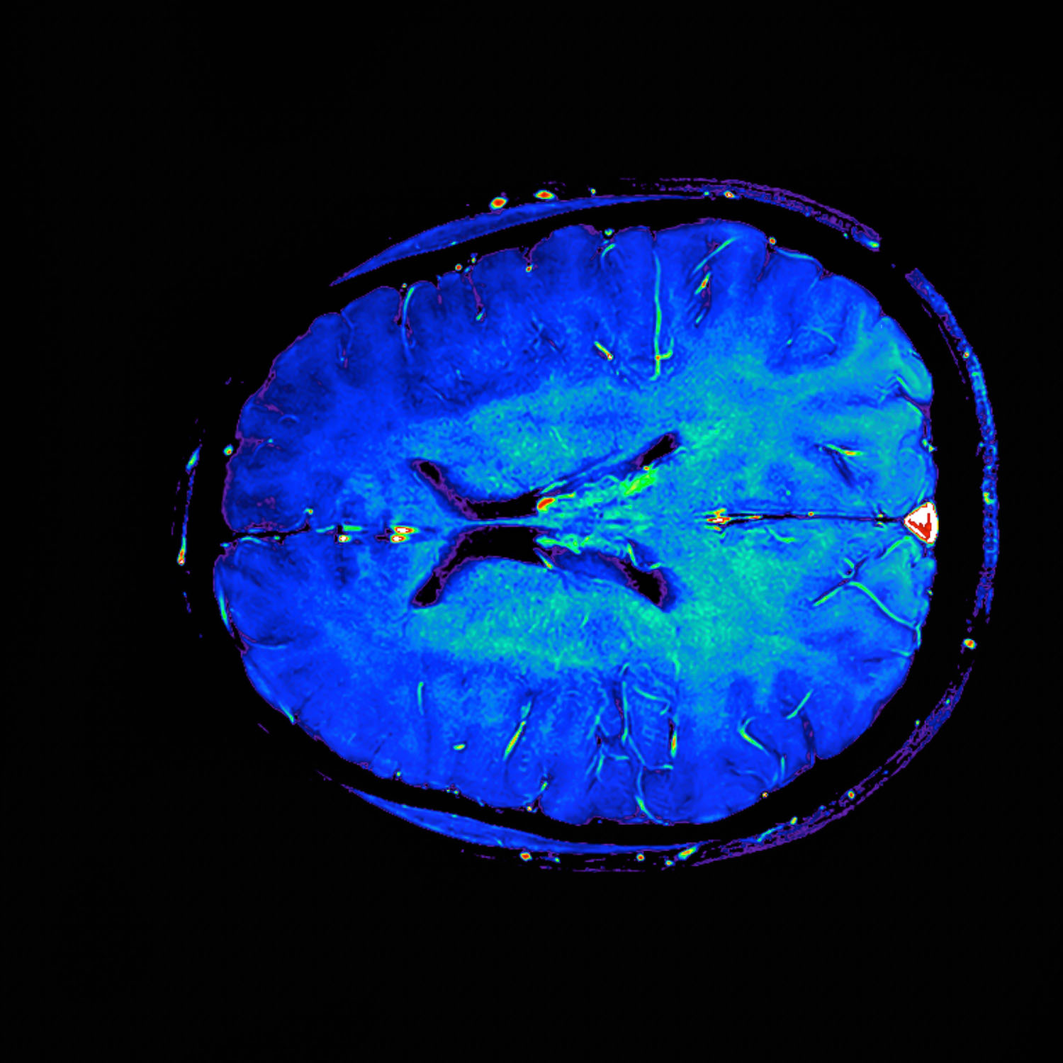 Hersenscans sporen alzheimer op