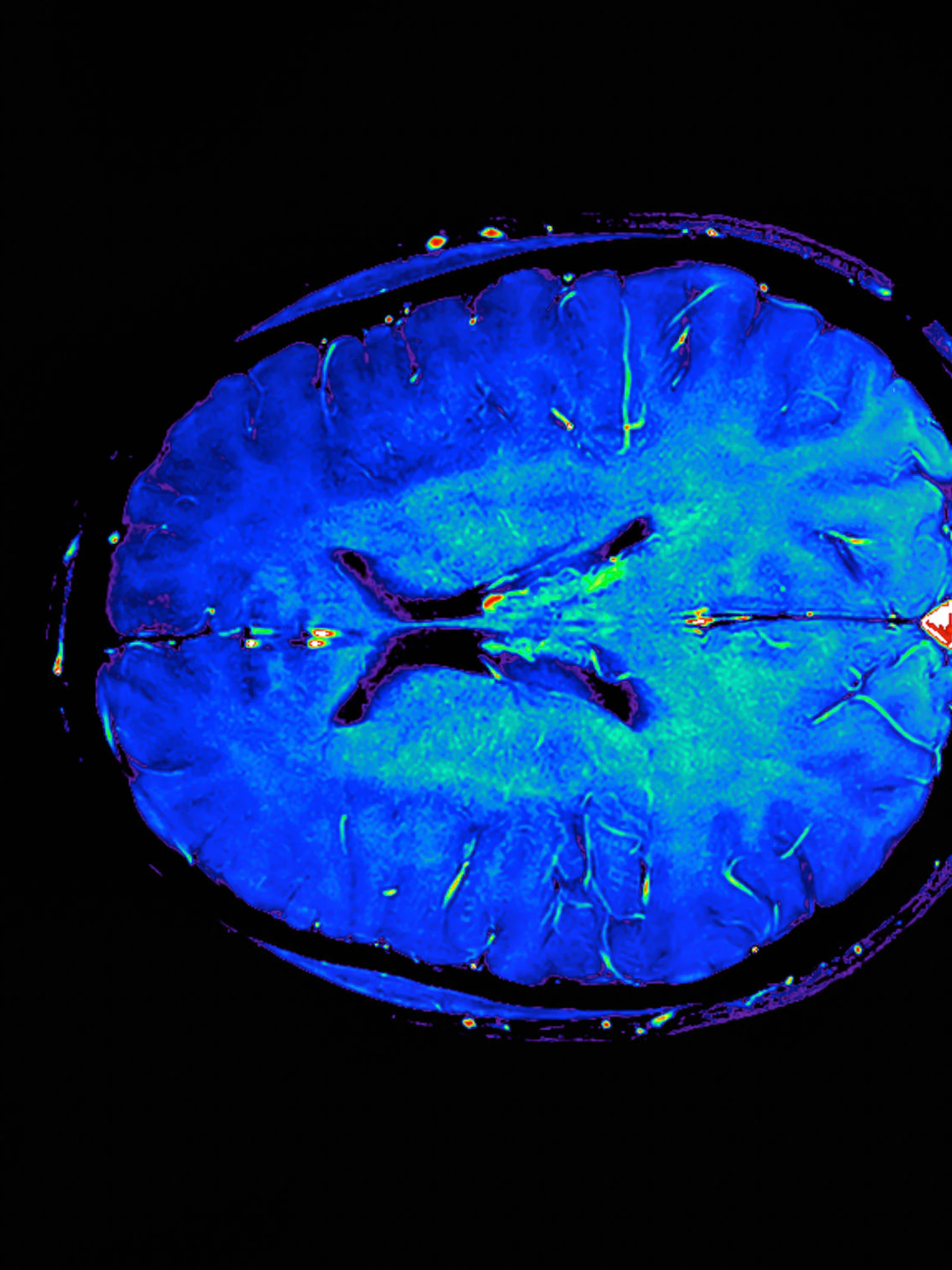 Hersenscans sporen alzheimer op