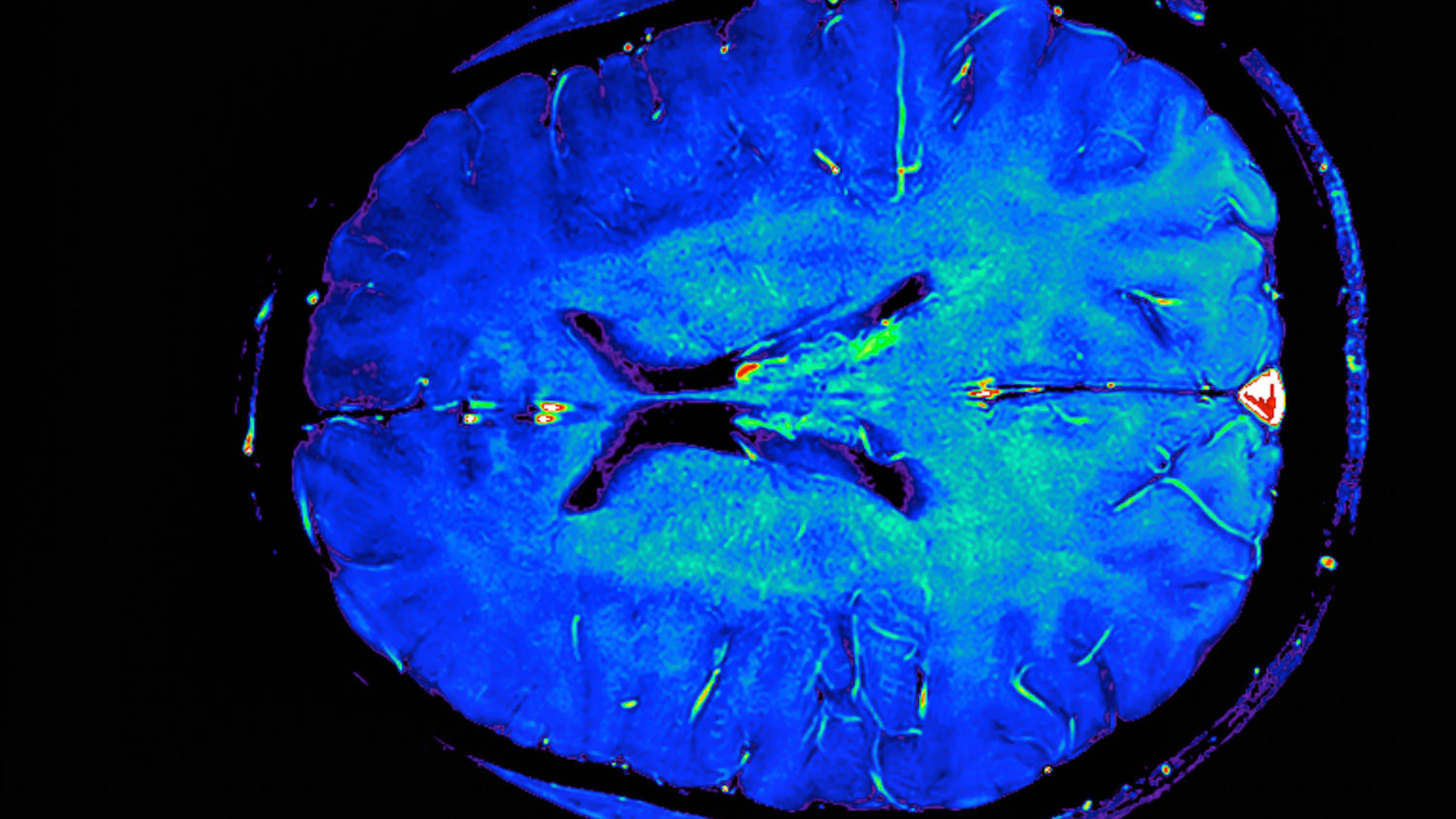 Hersenscans sporen alzheimer op