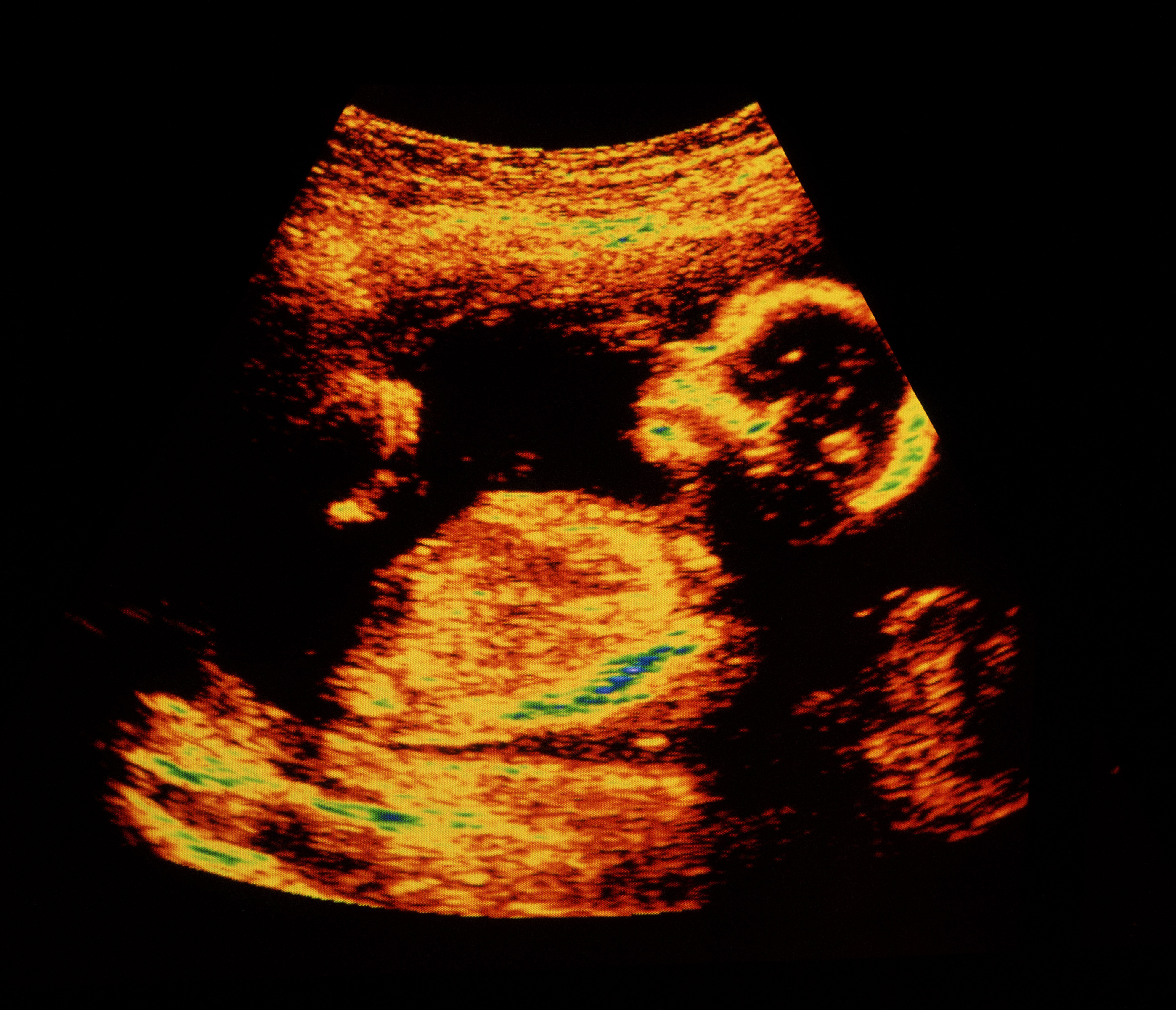 Vanaf wanneer voelt een ongeboren baby pijn?