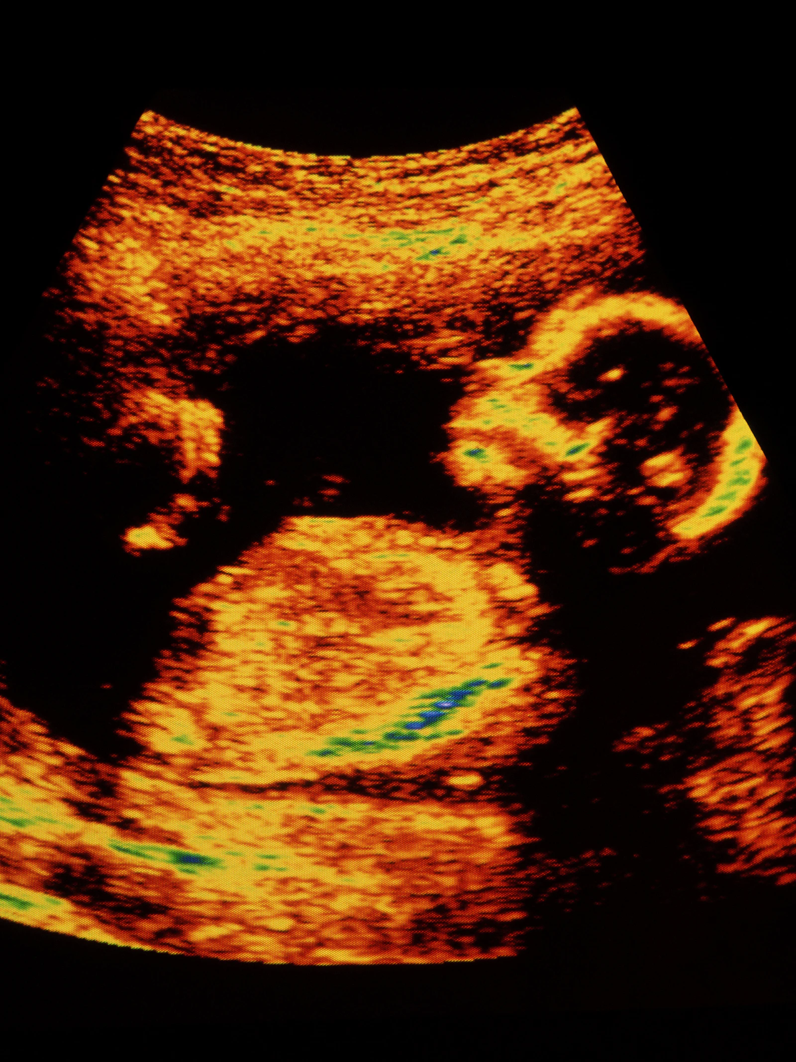 Vanaf wanneer voelt een ongeboren baby pijn?