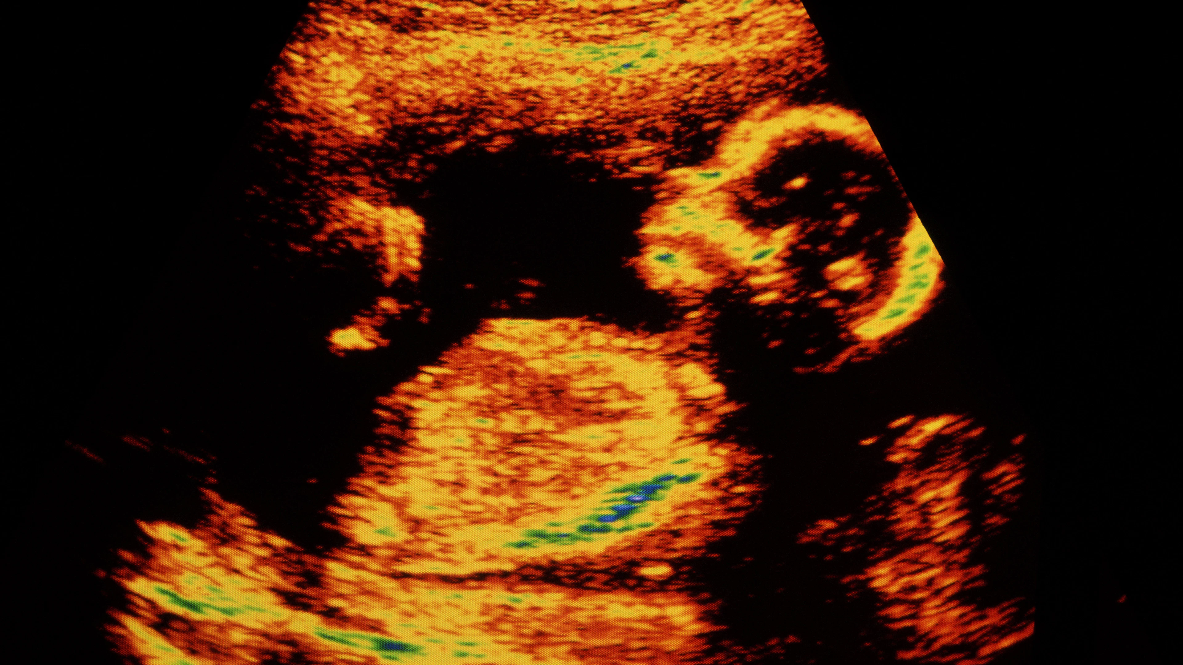 Vanaf wanneer voelt een ongeboren baby pijn?