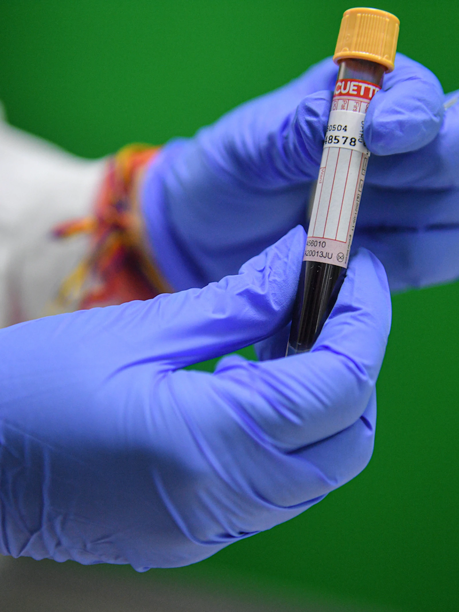 Covid-19 behandelen met bloedplasma: een goed idee?