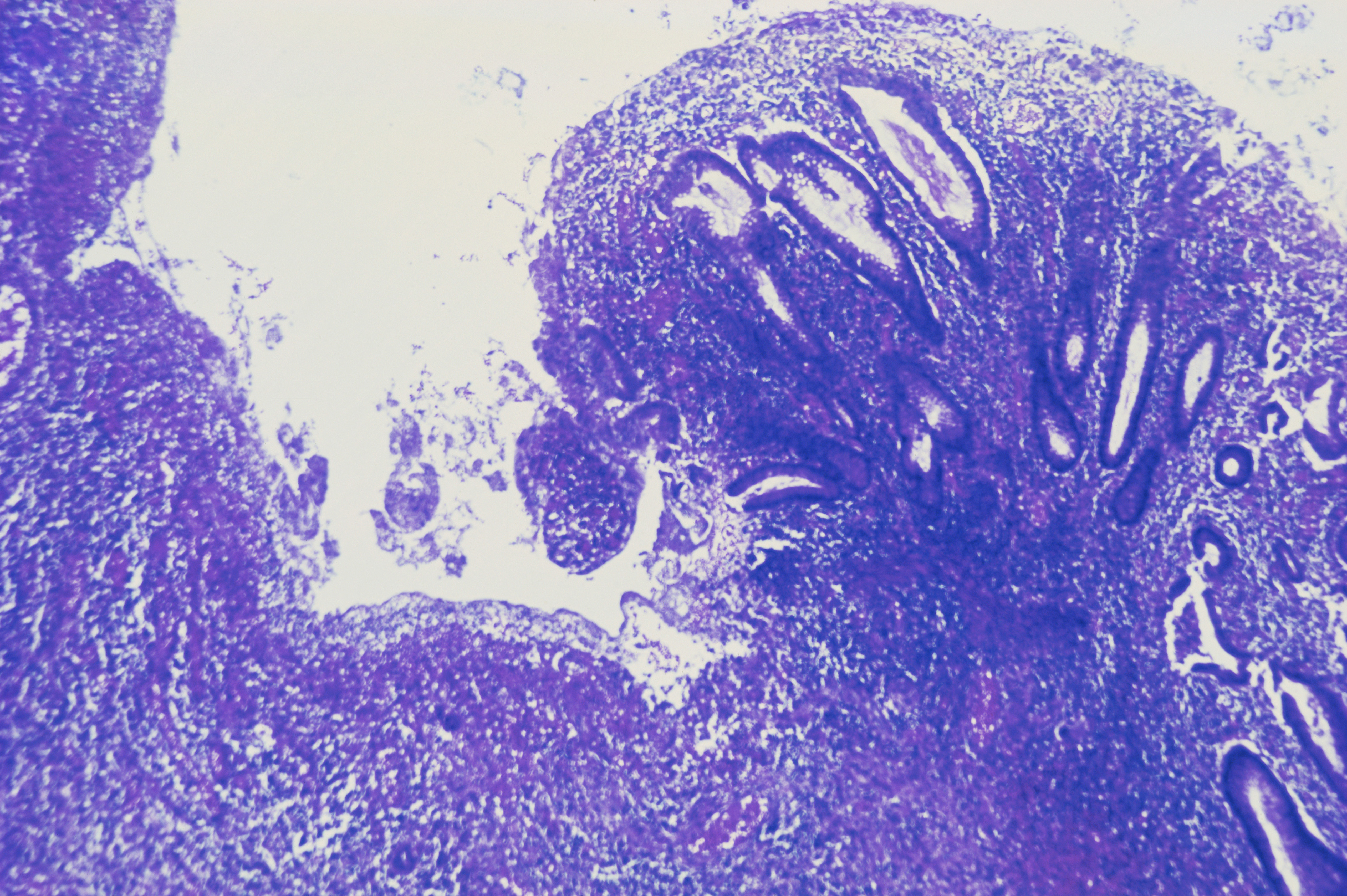 Effectievere behandeling van inflammatoire darmziekten, zoals de ziekte van Crohn en colitis ulcerosa, in de maak