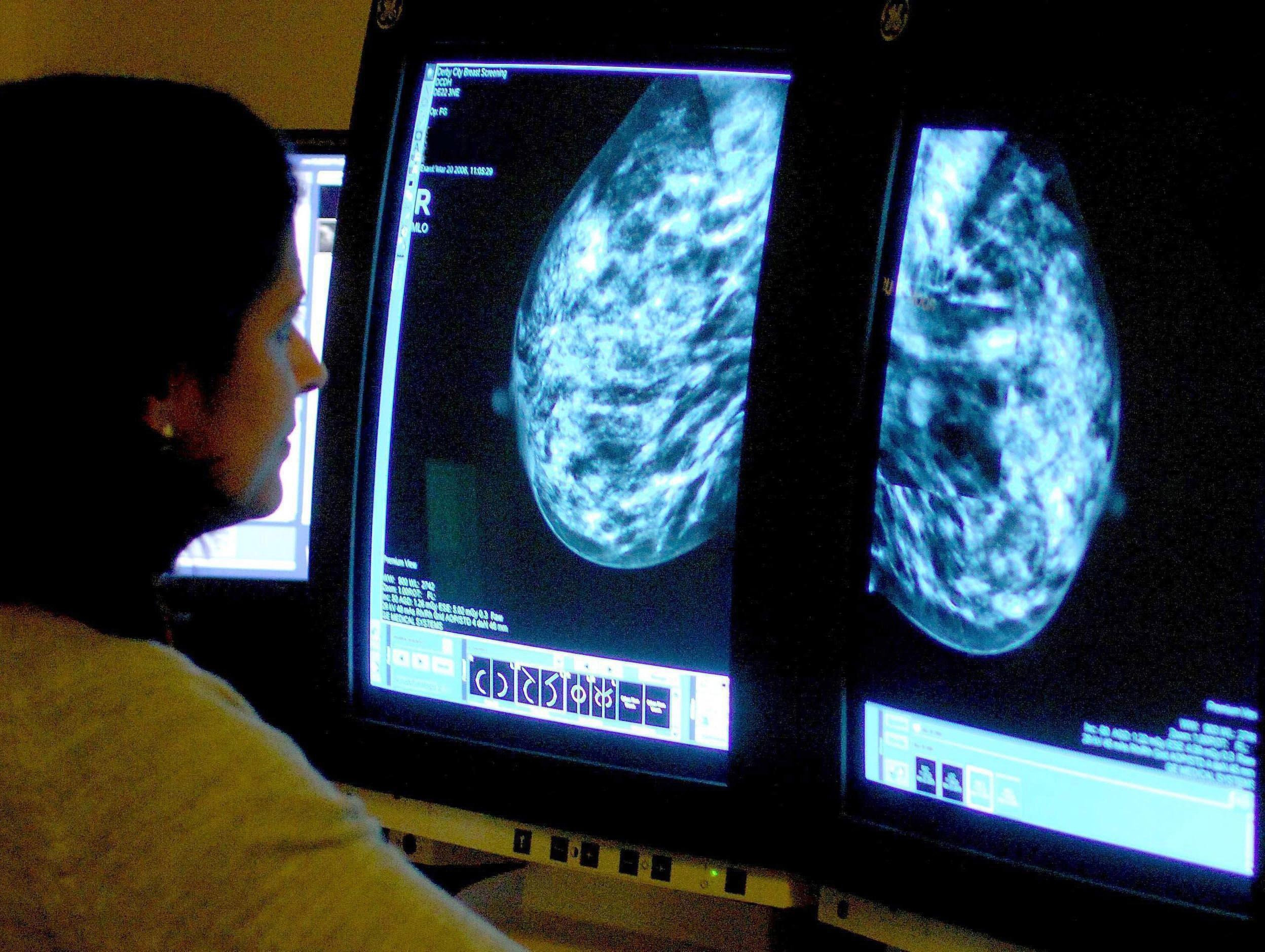 Chemotherapie bij borstkanker vaak overbodig